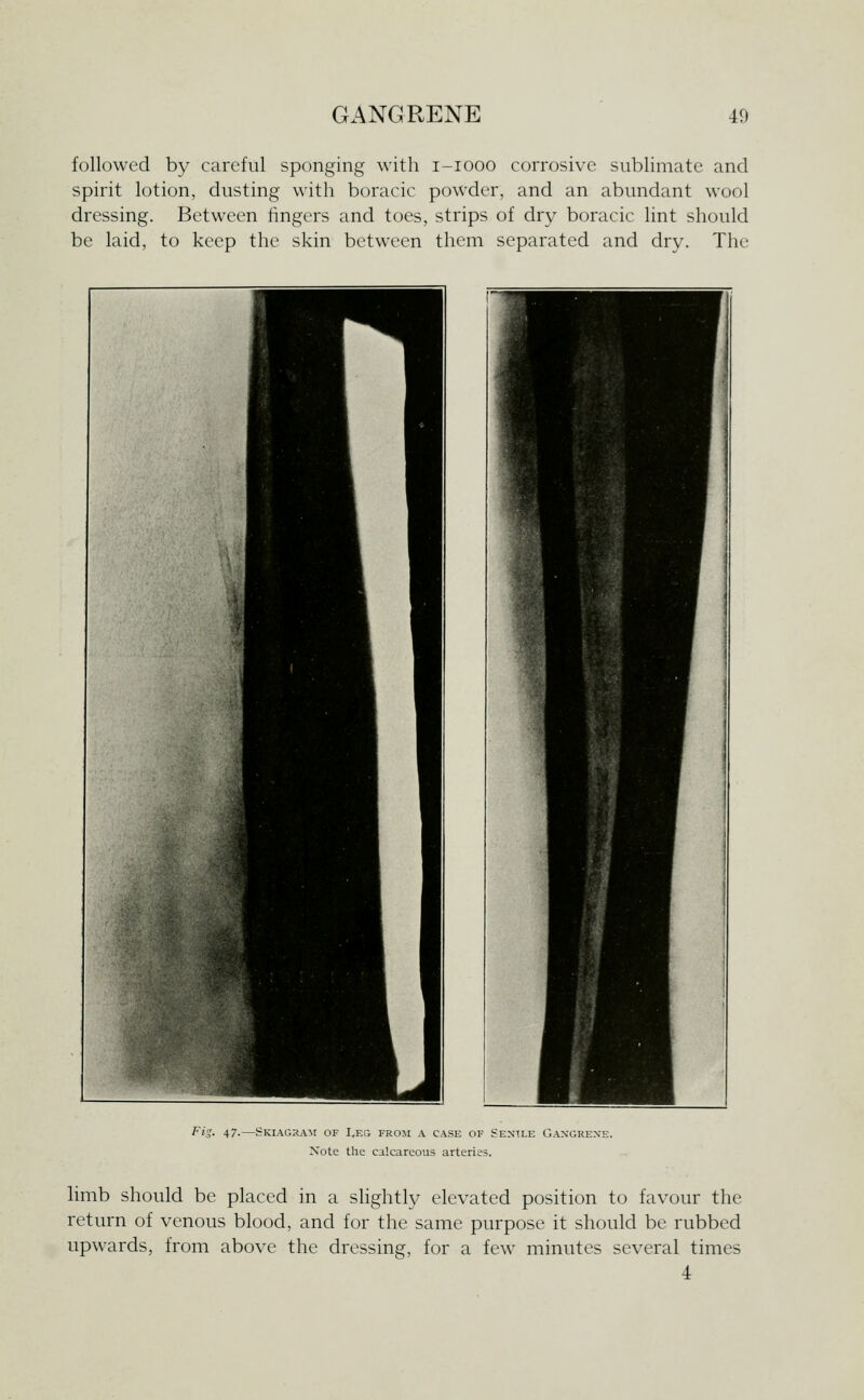 followed by careful sponging with i-iooo corrosive sublimate and spirit lotion, dusting with boracic powder, and an abundant wool dressing. Between fingers and toes, strips of dry boracic lint should be laid, to keep the skin between them separated and dry. The Fis. 47-—-Skiagram of I,eg from a case of Senile Gangrene. Note the calcareous arteries. limb should be placed in a slightly elevated position to favour the return of venous blood, and for the same purpose it should be rubbed upwards, from above the dressing, for a few minutes several times 4