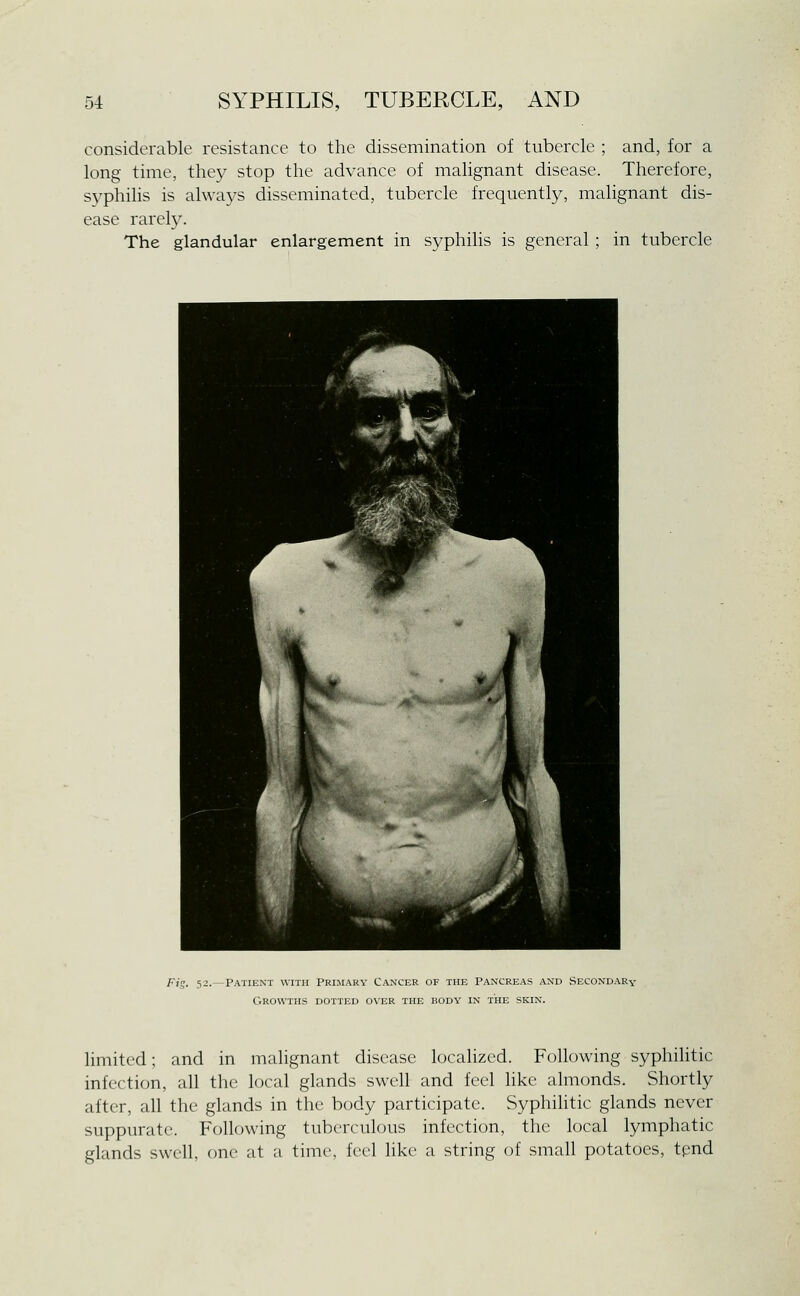 considerable resistance to the dissemination of tubercle ; and, for a long time, they stop the advance of malignant disease. Therefore, syphilis is always disseminated, tubercle frequently, malignant dis- ease rarely. The glandular enlargement in syphilis is general ; in tubercle 52.—Patient with Primary Cancer of the Pancreas and Secondary Growths dotted over the body in the skin. limited; and in malignant disease localized. Following syphilitic infection, all the local glands swell and feel like almonds. Shortly after, all the glands in the body participate. Syphilitic glands never suppurate. Following tuberculous infection, the local lymphatic glands swell, one at a time, feel like a string of small potatoes, tpnd