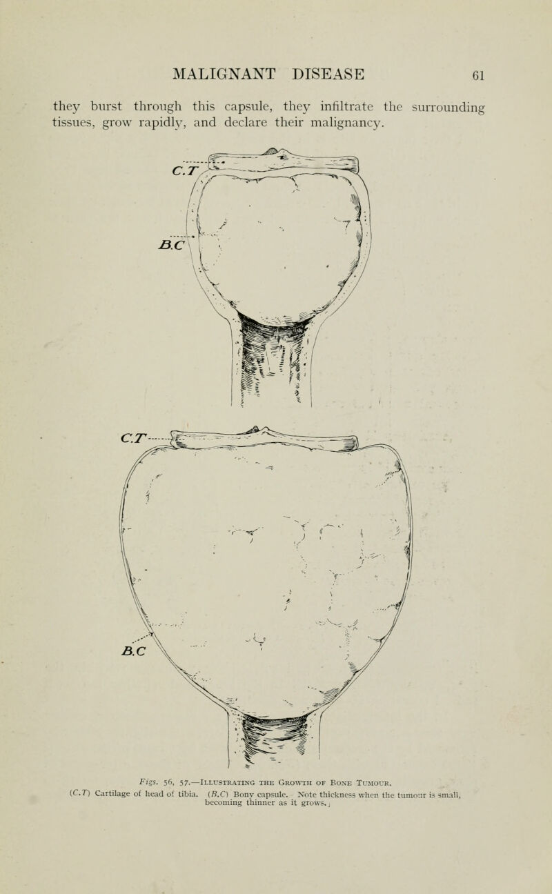 they burst through this capsule, they infiltrate the surrounding tissues, grow rapidly, and declare their malignancy. Fi^s. 56, 57.—Illustrating the Growth of Bone TuMotit. {C.T) Cartilage of head of tibia. (R.C) Bony capsule. Note thickness when the tumour is small, becoming thinner as it grows. .