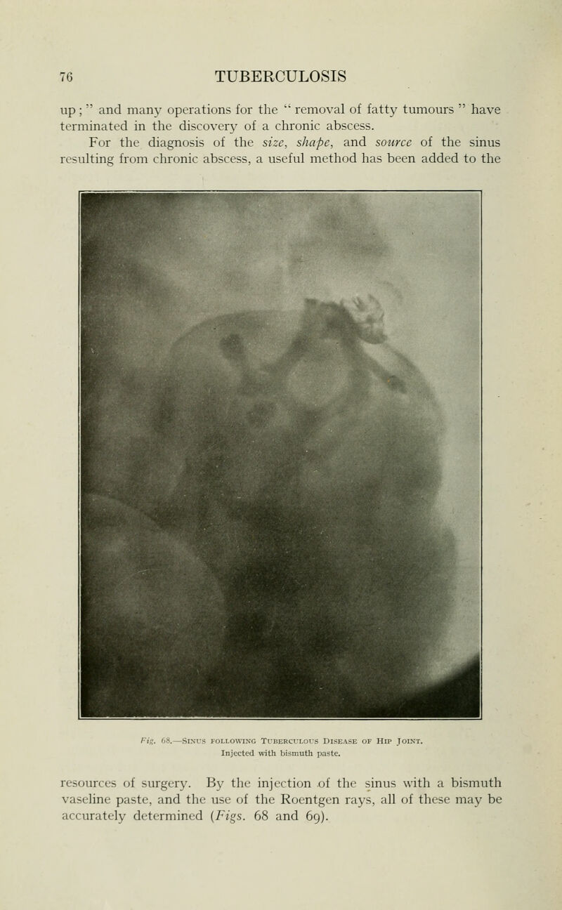 up;  and many operations for the  removal of fatty tumours  have terminated in the discovery of a chronic abscess. For the diagnosis of the size, shape, and source of the sinus resulting from chronic abscess, a useful method has been added to the rig. 68.—SlNX'S FOLLOWING TUBERCULOUS DISEASE OF HiP JOINT. Injected with bismuth paste. resources of surgery. By the injection of the sinus with a bismuth vaseline paste, and the use of the Roentgen rays, all of these may be accurately determined {Figs. 68 and 69).