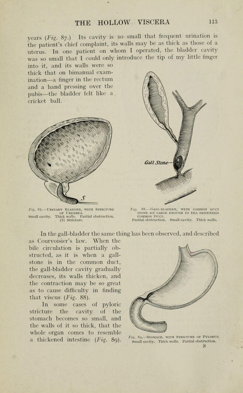 years {Fig. 87.) Its cavity is so small that frequent urination is the patient's chief complaint, its walls may be as thick as those of a uterus. In one patient on whom I operated, the bladder cavity was so small that I could only introduce the tip of my little linger into it, and its walls were so thick that on bimanual exam- ination—a linger in the rectum and a hand pressing over the pubis—the bladder felt Hke a cricket ball. Fig. 87.—Urinary Bladder, with Stricture OF Urethra. Small cavity. Thick walls. Partial obstruction. (.S) Stricture. Fig. 88.—Gall-bladder, \\^TH common duct STONE not LARGE ENOUGH TO FILL DISTENDED Common Duct. Partial obstruction. Small cavity. Thick walls. In the gall-bladder the same thing has been observed, and described as Courvoisier's law. When the bile circulation is partially ob- structed, as it is when a gall- stone is in the common duct, the gall-bladder cavity gradually decreases, its walls thicken, and the contraction may be so great as to cause difficulty in finding that viscus {Fig. 88). In some cases of pyloric stricture the cavity of the stomach becomes so small, and the walls of it so thick, that the whole organ comes to resemble .i-i J • J. A.- , T^ ■ r>\ Fig. 8n.—Stomach, with Strictl-re of Pyloru.s. a thickened mtestme {Fig. 89). small cavity. Thick walls. partial obstmction. 8