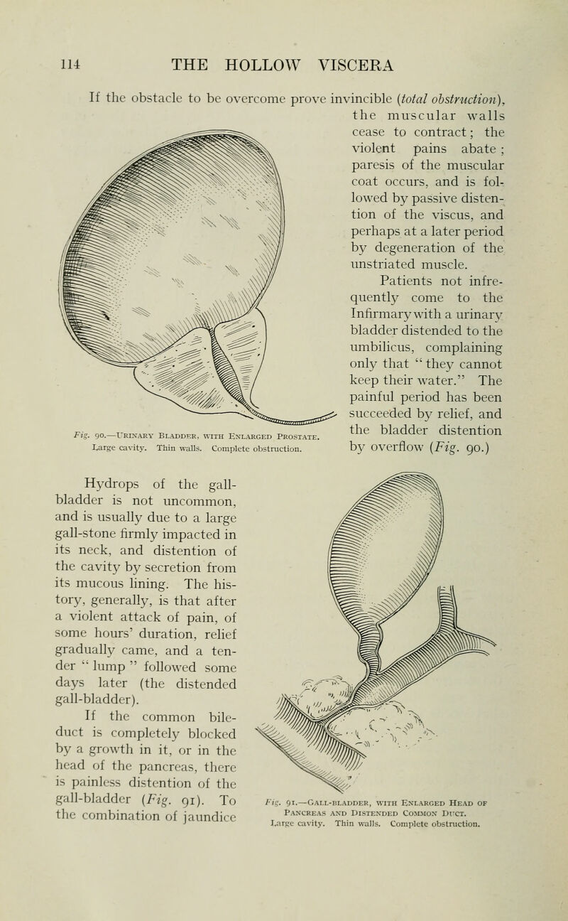 If the obstacle to be overcome prove invincible {total obstruction), the muscular walls cease to contract; the violent pains abate ; paresis of the muscular coat occurs, and is fol- lowed by passive disten- tion of the viscus, and perhaps at a later period by degeneration of the unstriated muscle. Patients not infre- quently come to the Infirmary with a urinary bladder distended to the umbilicus, complaining only that  they cannot keep their water. The painful period has been succeeded by relief, and Fi,. 90.-URIXARV BLADDER, ^^1XH EXLARGED PROSTATE. ^^^ bladdCr distCntiOU I^rge cavit.v. Thin walls. Complete obstruction. by OVCrfloW {Fig. 9O.) Hydrops of the gall- bladder is not uncommon, and is usually due to a large gall-stone iirmly impacted in its neck, and distention of the cavity by secretion from its mucous lining. The his- tory, generally, is that after a violent attack of pain, of some hours' duration, relief gradually came, and a ten- der  lump  followed some days later (the distended gall-bladder). If the common bile- duct is completely blocked by a growth in it, or in the head of the pancreas, there is painless distention of the gall-bladder {Fig. 91). To the combination of jaundice Fiq. 91.—Gai.l-bladder, with Enlarged Head of Pancrea.s and Dlstended CoiLMON Duct. Large cavity. Thin walls. Complete obstruction.