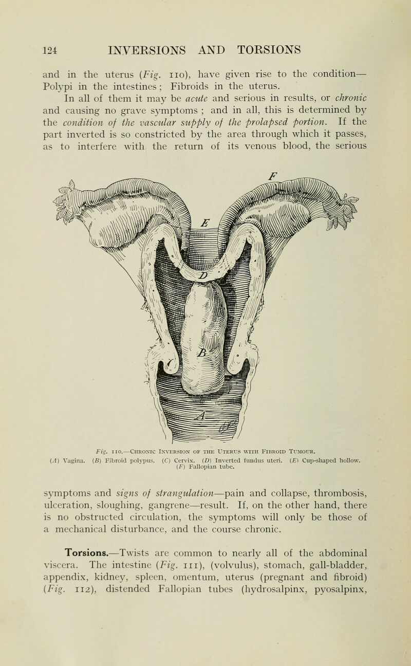 and in the uterus {Fig. no), have given rise to the condition— Polypi in the intestines ; Fibroids in the uterus. In all of them it ma}^ be acute and serious in results, or chronic and causing no grave symptoms ; and in all, this is determined by the condition of the vascular supply of the prolapsed portion. If the part inverted is so constricted by the area through which it passes, as to interfere with the return of its venous blood, the serious Fig. no.—Chronic Inversion of the Uterus with Fibroid Tu.aiour. {A) Vagina. (B) Fibroid polj-pus. (C) Cervix. (D) Inverted fundus uteri. (£) Cup-shaped hollow. (F) Fallopian tube. symptoms and signs of strangulation—pain and collapse, thrombosis, ulceration, sloughing, gangrene—result. If, on the other hand, there is no obstructed circulation, the symptoms will only be those of a mechanical disturbance, and the course chronic. Torsions.—Twists are common to nearly all of the abdominal viscera. The intestine {Fig. in), (volvulus), stomach, gall-bladder, appendix, kidney, spleen, omentum, uterus (pregnant and fibroid) {Fig. 112), distended Fallopian tubes (hydrosalpinx, pyosalpinx,