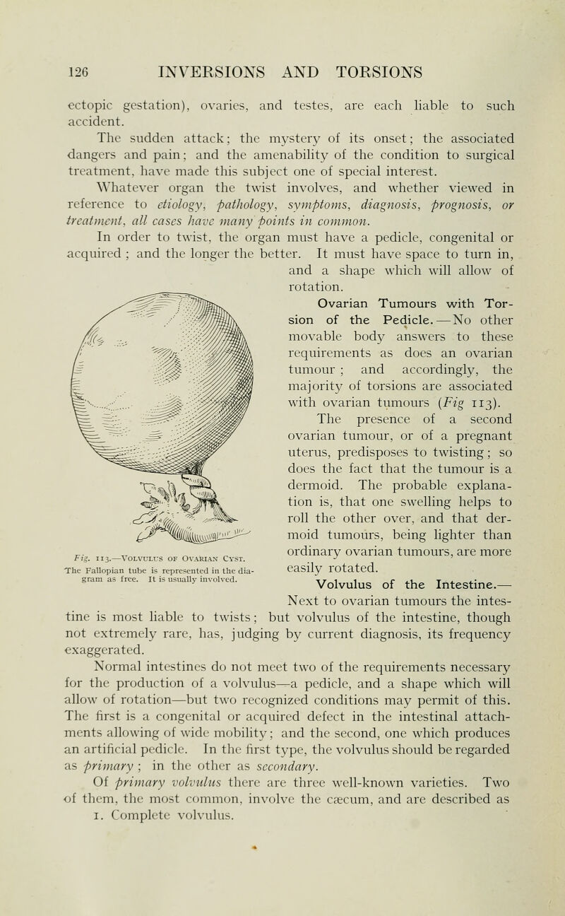 ectopic gestation), ovaries, and testes, are each liable to such accident. The sudden attack; the mystery of its onset; the associated dangers and pain; and the amenability of the condition to surgical treatment, have made this subject one of special interest. Whatever organ the twist involves, and whether viewed in reference to etiology, pathology, symptoms, diagnosis, prognosis, or treatment, all cases have many points in common. In order to twist, the organ must have a pedicle, congenital or acquired ; and the longer the better. It must have space to turn in, and a shape which will allow of rotation. Ovarian Tumours with Tor- sion of the Pedicle,—No other movable body answers to these requirements as does an ovarian tumour ; and accordingly, the majority of torsions are associated with ovarian tumours {Fig T13). The presence of a second ovarian tumour, or of a pregnant uterus, predisposes to twisting; so does the fact that the tumour is a dermoid. The probable explana- tion is, that one swelling helps to roll the other over, and that der- moid tumours, being lighter than ordinary ovarian tumours, are more easily rotated. Volvulus of the Intestine.— Next to ovarian tumours the intes- tine is most liable to twists; but volvulus of the intestine, though not extremely rare, has, judging by current diagnosis, its frequency exaggerated. Normal intestines do not meet two of the requirements necessary for the production of a volvulus—a pedicle, and a shape which will allow of rotation—but two recognized conditions may permit of this. The first is a congenital or acquired defect in the intestinal attach- ments allowing of wide mobihty; and the second, one which produces an artificial pedicle. In the first type, the volvulus should be regarded as primary ; in the other as secondary. Of primary volvulus there are three w^dl-known varieties. Two of them, the most common, involve the caecum, and are described as I. Complete volvulus. ^T^ikmm-j^ Fig. 113.—Volvulus of Ovarian Cyst. The Fallopian tube is represented in the dia- gram as free. It is usually involved.