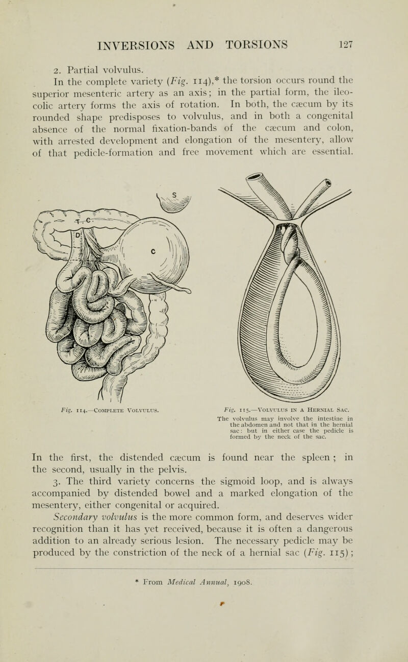 2. Partial volvulus. In the complete variet}- {Fig. 114),* the torsion occurs round the superior mesenteric artery as an axis; in the partial form, the ile(j- coHc artery forms the axis of rotation. In both, the caecum by its rounded shape predisposes to volvulus, and in both a congenital absence of the normal fixation-bands of the cacuni and colon, with arrested development and elongation of the mesentery, allow of that pedicle-formation and free movement which are essential. Fig. 114.—Complete Volvulus. 115. VOLVULU Hernial Sac. The volvulus may involve the intestine in the abdomen and not that in the hernial sac: but in either case the pedicle is formed by the neck of the sac. In the first, the distended caecum is found near the spleen ; in the second, usually in the pelvis. 3. The third variety concerns the sigmoid loop, and is always accompanied by distended bowel and a marked elongation of the mesentery, either congenital or acquired. Secondary volvulus is the more common form, and deserves wider recognition than it has yet received, because it is often a dangerous addition to an already serious lesion. The necessary pedicle may be produced by the constriction of the neck of a hernial sac {Fig. 115); * From Medical Annual, 190S.