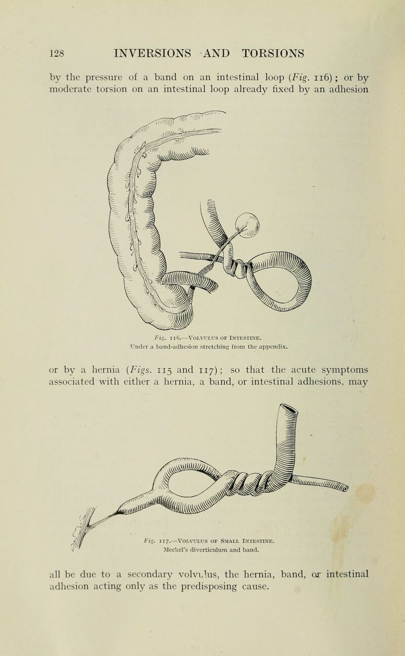 by the pressure of a band on an intestinal loop {Fig. ii6); or by moderate torsion on an intestinal loop already fixed by an adhesion Fig. 116.—Volvulus of Intestine. Under a band-adhesion stretching from the appendix. or by a hernia {Figs. 115 and 117); so that the acute symptoms associated with either a hernia, a band, or intestinal adhesions, may Fig. 117.—Volvulus of .Small Intestine. Jleckel's diverticulum and band. aU be due to a secondary volvi.lus, the hernia, band, or intestinal adhesi(jn acting only as the predisposing cause.