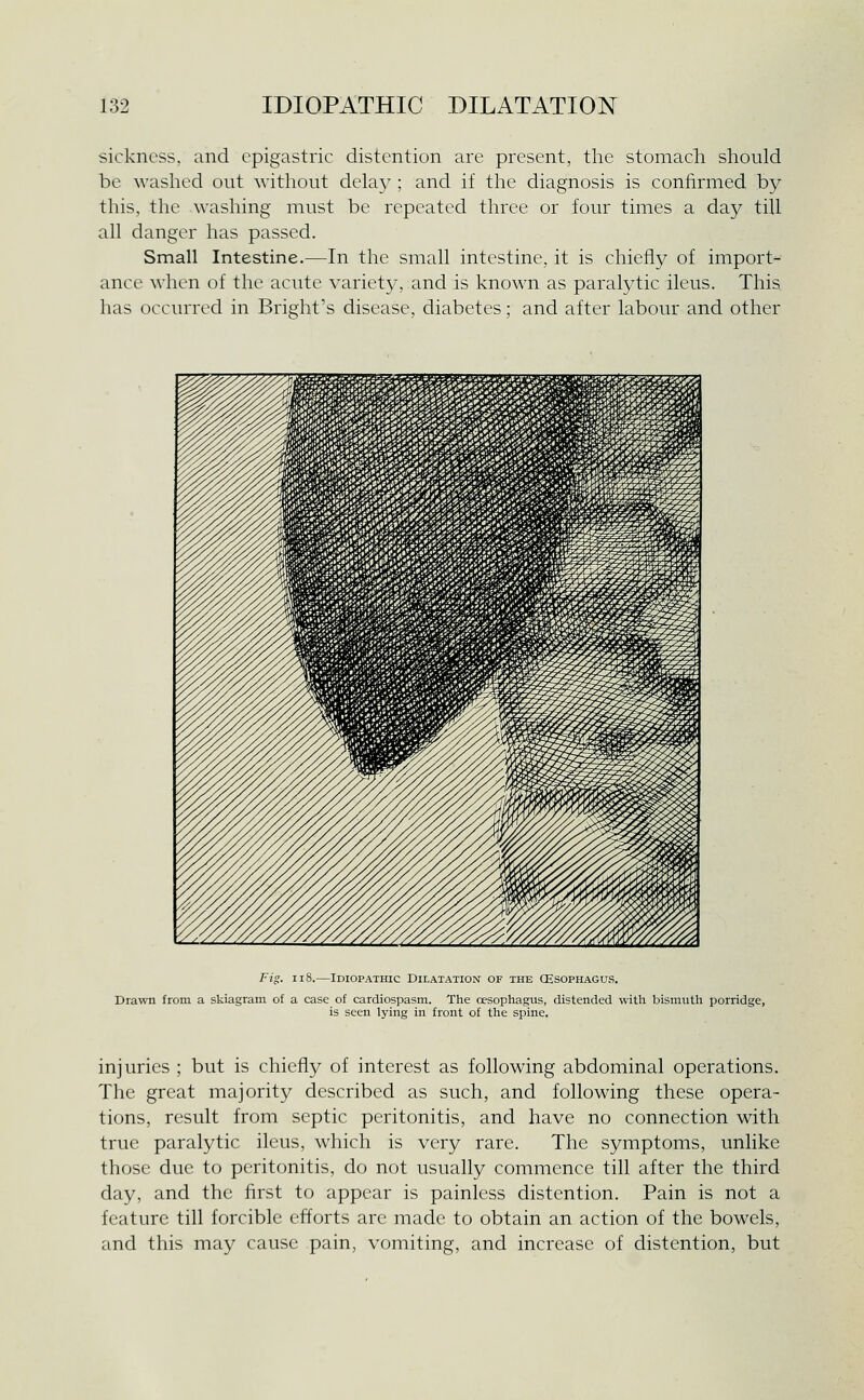 sickness, and epigastric distention are present, the stomach should be washed out without delay ; and if the diagnosis is confirmed by this, the washing must be repeated three or four times a day till all danger has passed. Small Intestine.—In the small intestine, it is chiefly of import- ance when of the acute variety, and is known as paralytic ileus. This has occurred in Bright's disease, diabetes; and after labour and other Fig. 118.—Idiopathic Dilatation of the CEsophagus. Drawn from a skiagram of a case of cardiospasm. The oesophagus, distended with bismuth porridge, is seen lying in front of the spine. injuries ; but is chiefly of interest as following abdominal operations. The great majority described as such, and following these opera- tions, result from septic peritonitis, and have no connection with true paralytic ileus, which is very rare. The symptoms, unlike those due to peritonitis, do not usually commence till after the third day, and the first to appear is painless distention. Pain is not a feature till forcible efforts arc made to obtain an action of the bowels, and this may cause pain, vomiting, and increase of distention, but