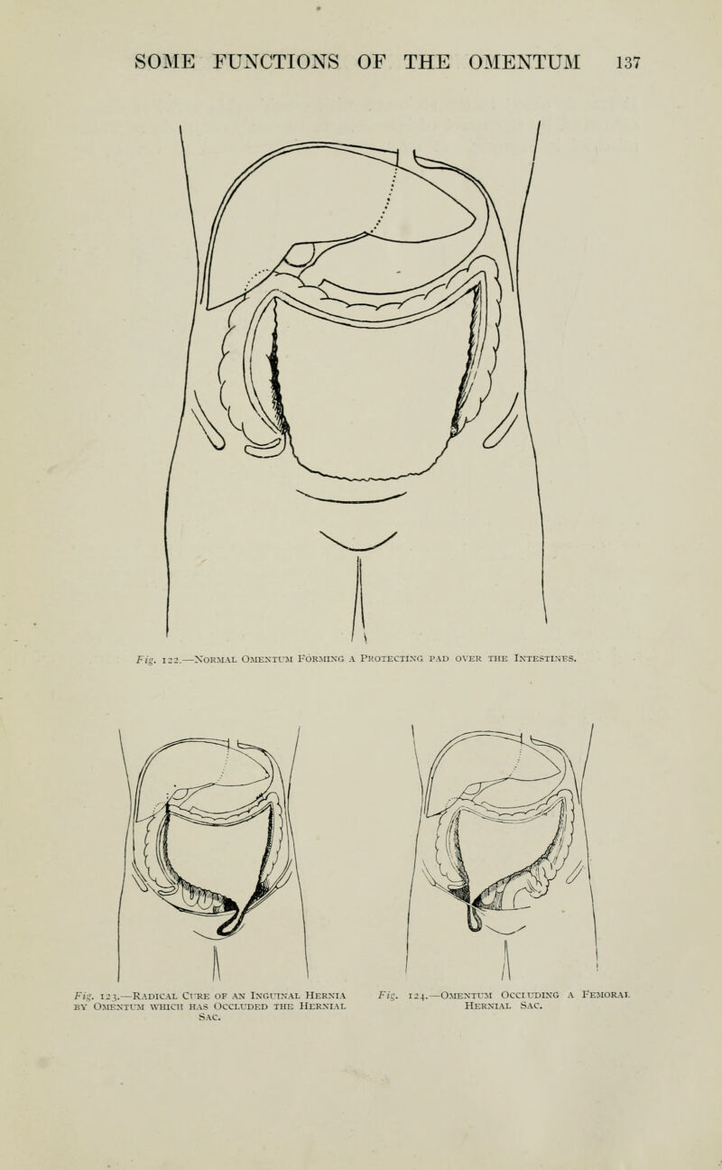 F/i?. 122.—Normal Omextim Formixg a Proxectixg pad over the Intestines. Fig. 123.—Radical Ct-re of an INGL^NAL Herxia BY Omentum which has Occluded the Hernial Sac. Fig. 124.—OirEXTUM Occluding a Femoral Hernial Sac.