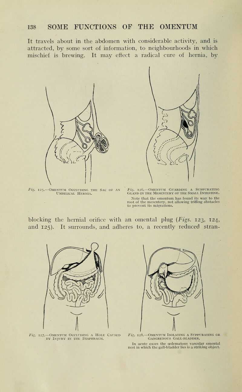 It travels about in the abdomen with considerable activity, and is attracted, by some sort of information, to neighbourhoods in which mischief is brewing. It may effect a radical cure of hernia, by 125.—Ojientum Occluding the Sac of an- Umbilical Hernia. Fj?. 126.—Omentum Guarding a Sltpurating Gland in the Mesentery of the Small Intestine. Note that the omentum has found its way to the root of the mesentery, not allowing trifling obstacles to prevent its migrations. blocking the hernial orifice with an omental plug {Figs. 123, 124, and 125). It surrounds, and adheres to, a recently reduced stran- 127.—Omenti'M Occlcdino a Hole Caused BV Injury in the Jjiai-hracjl Fif;. 128.—Omentum Isolating a Suppurating or Gangrenous Gall-bladder. In acute cases the oedcmatous vascular omental nest in which the gall-bladder lies is a striking object.