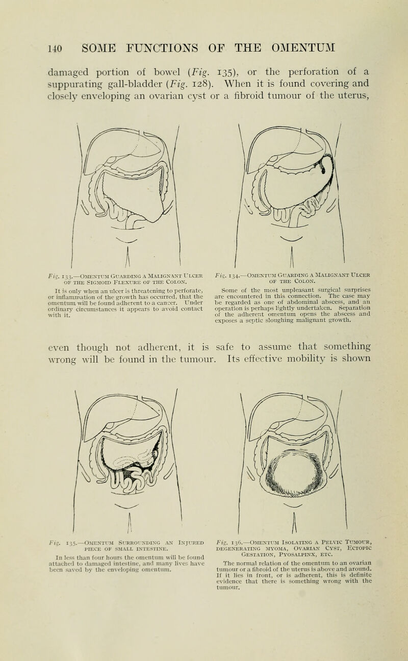 damaged portion of bowel {Fig. 135), or the perforation of a suppurating gall-bladder {Fig. 128). When it is found covering and closely enveloping an ovarian cyst or a fibroid tumour of the uterus, Fig. 133. OlIENTUlI GU.\RDING A MALIGN.^^T ULCER OF THE vSlGJIOID FLEXURE OF THE COLON. It is only when an ulcer is threatening to perforate, or inflamniation of the growth has occurred, that the omentum will be found adherent to a cancer. Under ordinary circumstances it appears to avoid contact with it. Fk. I34-- -OiiENTUJi Guarding a JL\lignant Ulcer OF THE Colon. Some of the most unpleasant surgical surprises are encountered in this connection. The case may be regarded as one of abdominal abscess, and an operation is perhaps lightly undertaken. .Separation of the adherent omentum opens the abscess and exposes a septic sloughing malignant growth. even though not adherent, it is safe to assume that something wrong will be found in the tumour. Its effective mobihty is shown Fig. 135. -Omentum Surrounding an I-njured piece of small inte.stine. In less than four hours the omentum will be found attached to damaged intestine, and many lives have been saved by the cn\(loping omentum. Fig. 136.—Omentum Isolating a Pelvic Tumour, degenerating myoma, ovarian cyst, ectopic Gestation, Pyosalpinx, etc. The normal relation of the omentum to an ovarian tumour or a fibroid of the uterus is above and around. If it lies in front, or is adherent, this is definite evidence that there is something wrong with the tumour.