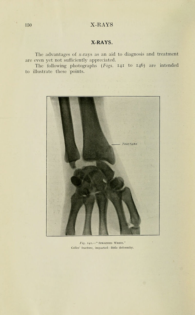 X-RAYS. The advantages of .r-rays as an aid to diagnosis and treatment are even yet not sui!iciently appreciated. Tlie following photographs {Figs. 141 to 146) are intended to illustrate these points. Fig. 141.— Sprained Wrist. Colles' fracture, impacted—little deformity.