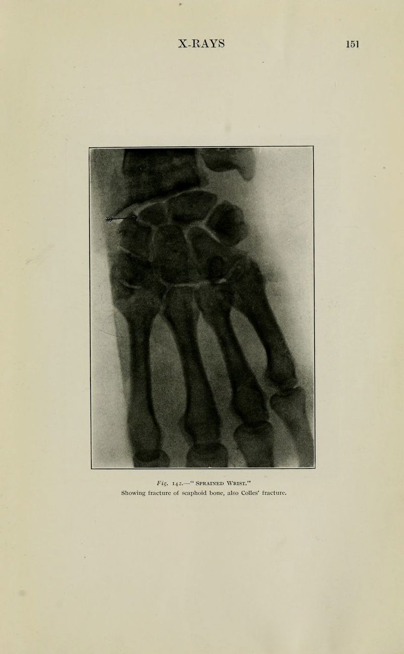 Fis. 142.— Sprained Wrist. Showing fracture of scaphoid bone, also CoUes' fracture.