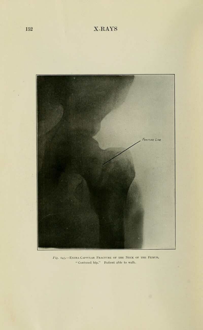 Fig. 143.—Extra Capsulak TRACTrRE of the Neck of the Femur.  Contused hip. Patient able to walk.