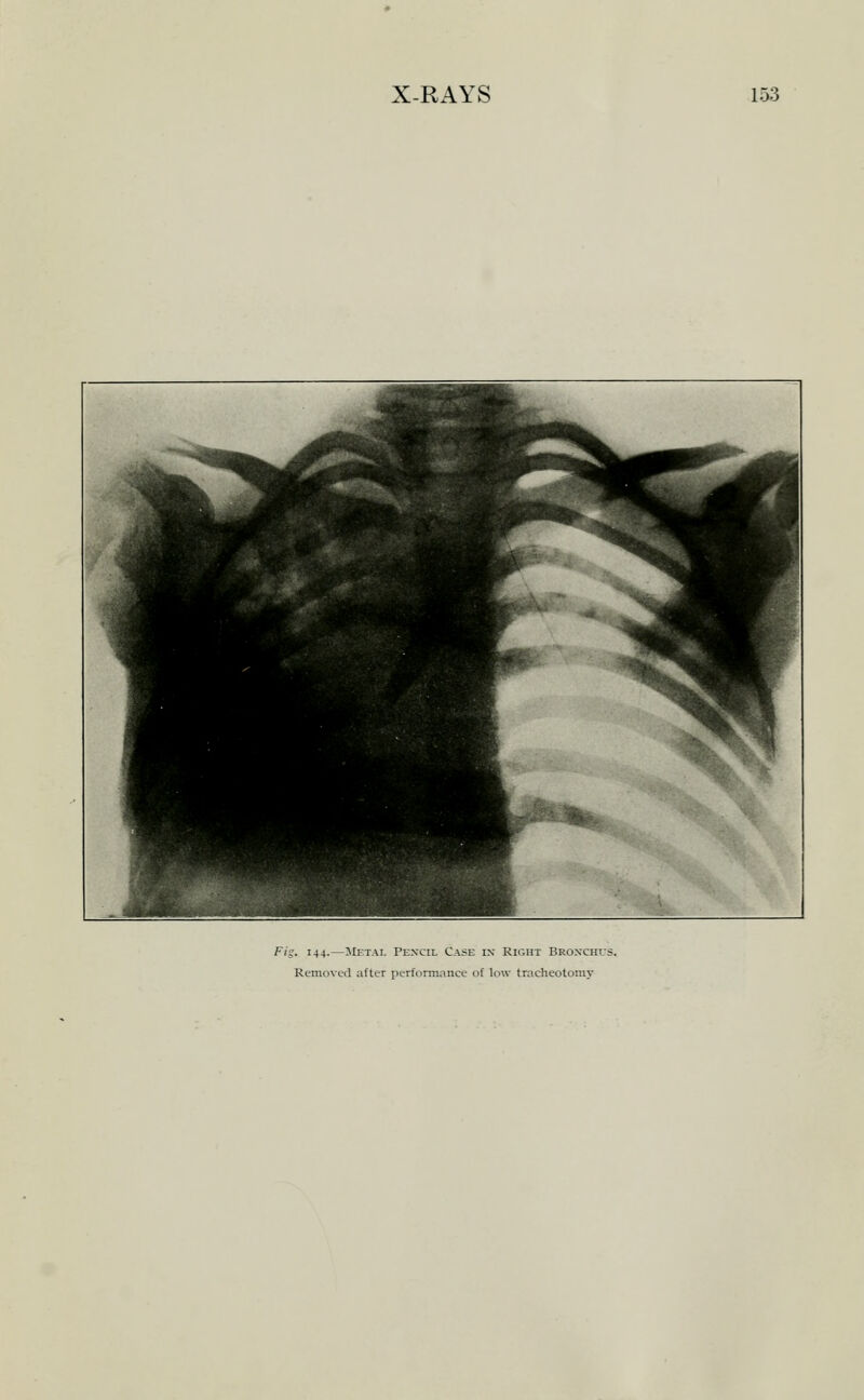 Fig. 144.—llETAL Pencil Case in Right Broxchls. Removed after performance of low tracheotomy