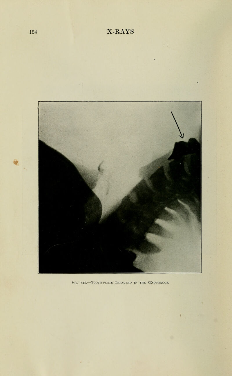 Fig. 145.—Tooth plate Impacted in the (Esophagus.