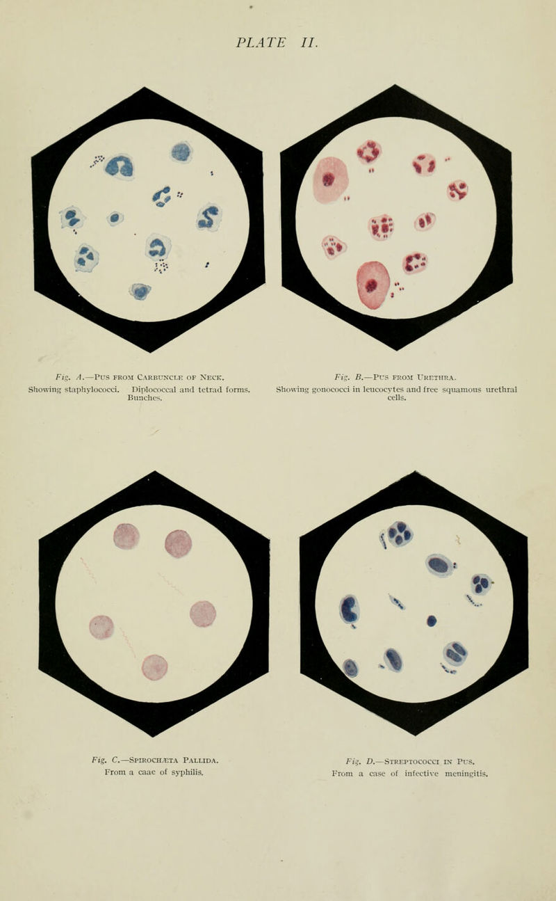 Fig. A.—Pus FROM Carbuncle of Neck. Showing staphylococci. Diplococcal and tetrad fonns. Bunches. Fig. B.—Pus FROM Urethra. Showing gonococci in leucocytes and free squamous urethral cells. Fig. C.—Spiroch.t:t.\ Pallida. From, a caae of syphilis. Fi^. D.—Streptococci in Pus. From a case of infective meningitis.