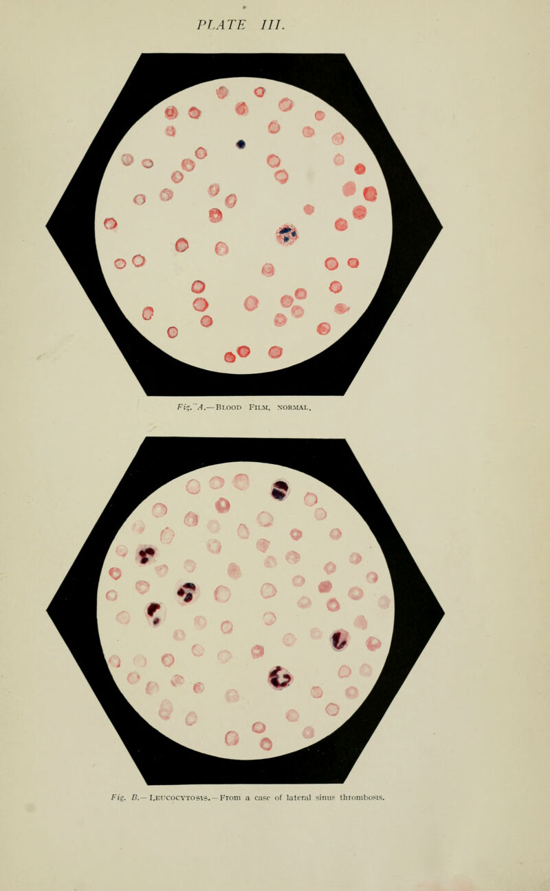 Fi^.'A.—Bi.ooD Film, normal. Fig. C—LEfcocYTOSls. —From a case of lateral sinuf thrombosis.