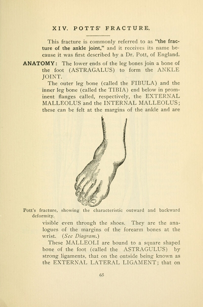 XIV. POTTS' FRACTURE. This fracture is commonly referred to as the frac- ture of the ankle joint, and it receives its name be- cause it was first described by a Dr. Pott, of England. ANATOMY: The lower ends of the leg bones join a bone of the foot (ASTRAGALUS) to form the ANKLE JOINT. The outer leg bone (called the FIBULA) and the inner leg bone (called the TIBIA) end below in prom- inent flanges called, respectively, the EXTERNAL MALLEOLUS and the INTERNAL MALLEOLUS; these can be felt at the margins of the ankle and are Pott's fracture, showing the characteristic outward and backward deformity. visible even through the shoes. They are the ana- logues of the margins of the forearm bones at the wrist. {See Diagram.) These MALLEOLI are bound to a square shaped bone of the foot (called the ASTRAGULUS) by strong ligaments, that on the outside being known as the EXTERNAL LATERAL LIGAMENT; that on