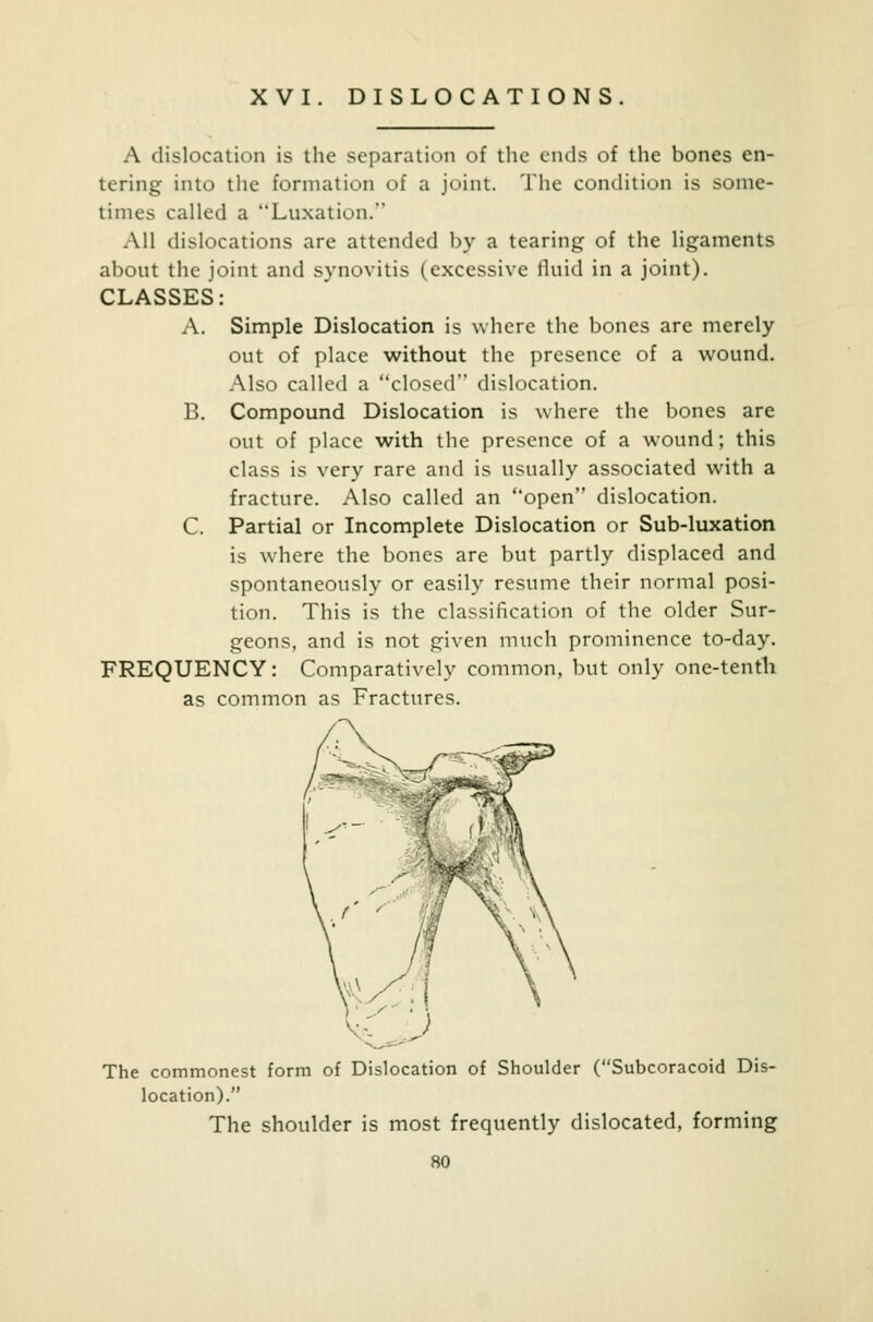 XVI. DISLOCATIONS A dislocation is the separation of the ends of the bones en- tering into the formation of a joint. The condition is some- times called a Luxation. All dislocations are attended by a tearing of the ligaments about the joint and synovitis (excessive fluid in a joint). CLASSES: Simple Dislocation is where the bones are merely out of place without the presence of a wound. Also called a closed dislocation. Compound Dislocation is where the bones are out of place with the presence of a wound; this class is very rare and is usually associated with a fracture. Also called an open dislocation. Partial or Incomplete Dislocation or Sub-luxation is where the bones are but partly displaced and spontaneously or easily resume their normal posi- tion. This is the classification of the older Sur- geons, and is not given much prominence to-day. FREQUENCY: Comparatively common, but only one-tenth as common as Fractures. A. B. C. The commonest form of Dislocation of Shoulder (Subcoracoid Dis- location). The shoulder is most frequently dislocated, forming