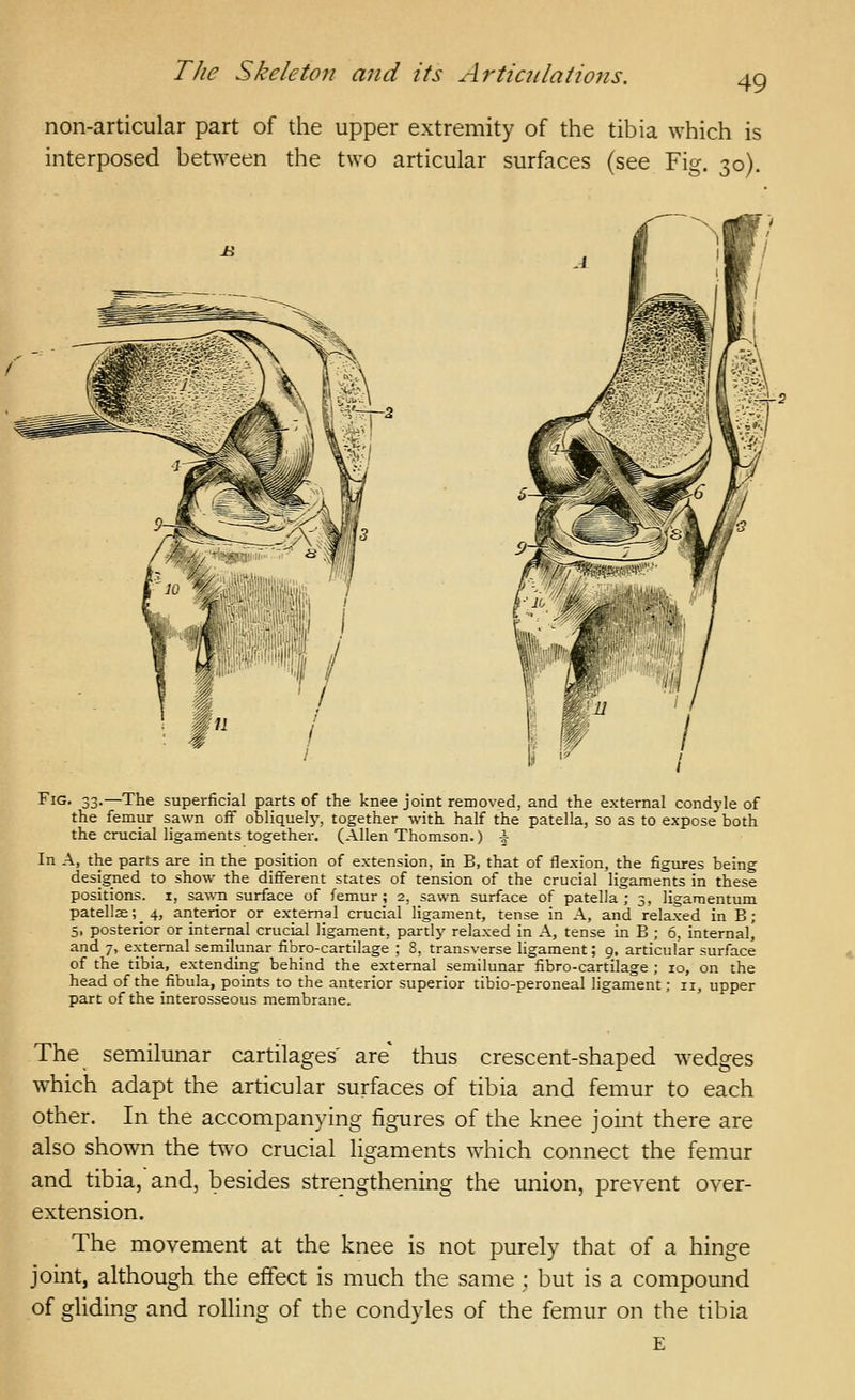 49 non-articular part of the upper extremity of the tibia which is interposed between the two articular surfaces (see Fig. 30). Fig. 33.—The superficial parts of the knee joint removed, and the external condyle of the femur sawn off obliquely-, together with half the patella, so as to expose both the crucial ligaments together, (Allen Thomson.) ^ In A, the parts are in the position of extension, in B, that of flexion, the figures being designed to show the different states of tension of the crucial ligaments in these positions, i, sa^ra surface of femur; 2, sawn surface of patella; 3, ligamentum patell2e;_4, anterior or external crucial ligament, tense in A, and relaxed in B; 5, posterior or internal crucial ligament, partly relaxed in A, tense in B ; 6, internal^ and 7, external semilunar fibro-cartilage ; 3, transverse ligament; 9, articular surface of the tibia, extending behind the external semilunar fibro-cartilage ; 10, on the head of thefibula, points to the anterior superior tibio-peroneal ligament; 11, upper part of the interosseous membrane. The semilunar cartilages' are* thus crescent-shaped wedges which adapt the articular surfaces of tibia and femur to each other. In the accompanying figures of the knee joint there are also shown the two crucial ligaments which connect the femur and tibia, and, besides strengthening the union, prevent over- extension. The movement at the knee is not purely that of a hinge joint, although the effect is much the same ; but is a compound of gliding and rolling of the condvles of the femur on the tibia
