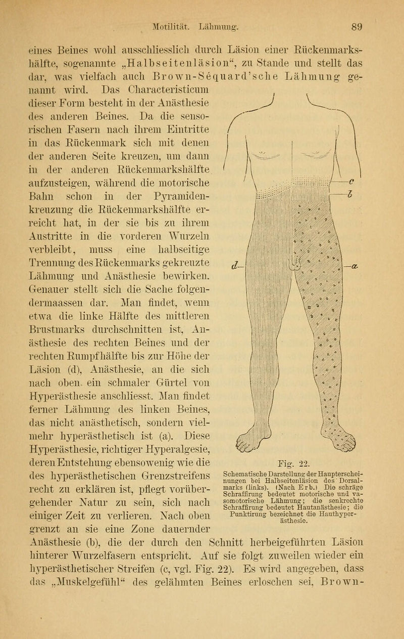 eines Beines wohl ausschliesslich durch Läsion einer Rückenmarks- hälfte, sogenannte „Halbseitenläsion, zu Stande und stellt das dar, was vielfach auch Brown-Sequard'sche Lähmung ge- nannt wird. Das Oharacteristicum dieser Form besteht in der Anästhesie des anderen Beines. Da die senso- rischen Fasern nach ihrem Eintritte in das Rückenmark sich mit denen der anderen Seite kreuzen, um dann in der anderen Rückenmarkshälfte aufzusteigen, während die motorische Bahn schon in der Pyramiden- kreuzung die Rückenmarkshälfte er- reicht hat, in der sie bis zu ihrem Austritte in die vorderen Wurzeln verbleibt, muss eine halbseitige Trennung des Rückenmarks gekreuzte Lähmung und Anästhesie bewirken. Genauer stellt sich die Sache folgen- dermaassen dar. Man findet, wenn etwa die linke Hälfte des mittleren Brustmarks durchschnitten ist, An- ästhesie des rechten Beines und der rechten Rumpf hälfte bis zur Höhe der Läsion (d), Anästhesie, an die sich nach oben, ein schmaler Gürtel von Hyperästhesie anschliesst. Man findet ferner Lähmung des linken Beines, das nicht anästhetisch, sondern viel- mehr hyperästhetisch ist (a). Diese Hyperästhesie, richtiger Hyperalgesie, deren Entstehung ebensowenig wie die des hyperästhetischen Grenzstreifens recht zu erklären ist, pflegt vorüber- gehender Natur zu sein, sich nach einiger Zeit zu verlieren. Nach oben grenzt an sie eine Zone dauernder Anästhesie (b), die der durch den Schnitt herbeigeführten Läsion hinterer Wurzelfasern entspricht. Auf sie folgt zuweilen wieder ein hyperästhetischer Streifen (c, vgl. Fig. 22). Es wird angegeben, dass das ..Muskelgefühl des gelähmten Beines erloschen sei. Brown- Schematische Darstellung der Haupterschei- nungen bei Halbseitenläsion des'Dorsal- marks (links). (Nach Erb.) Die schräge Schrafflrung bedeutet motorische und va- somotorische Lähmung; die senkrechte Schraffirung bedeutet Hautanästhesie; die Punktirung bezeichnet die Hauthyper- ästhesie.