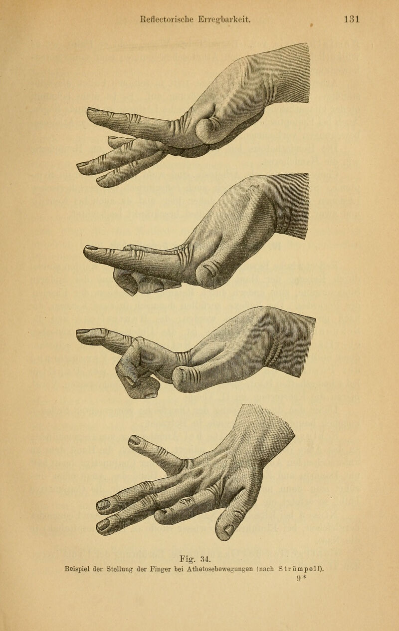 Fig. 34. Beispiel der Stellung der Finger bei Athetosebewegungen (nach Strümpell). 9*