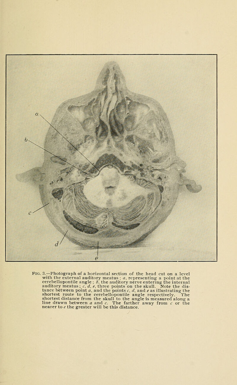 Fig. 3.—Photograph of a horizontal section of the head cut on a level with the external auditory meatus ; a, representing a point at the cerebellopontile angle ; b, the auditory nerve entering the internal auditory meatus ; c, d, e, three points on the skull. Note the dis- tance between point a, and the points c, d, and e as illustrating the shortest route to the cerebellopontile angle respectively. The shortest distance from the skull to the angle is measured along a line drawn between a and c. The farther away from c or the nearer to e the greater will be this distance.