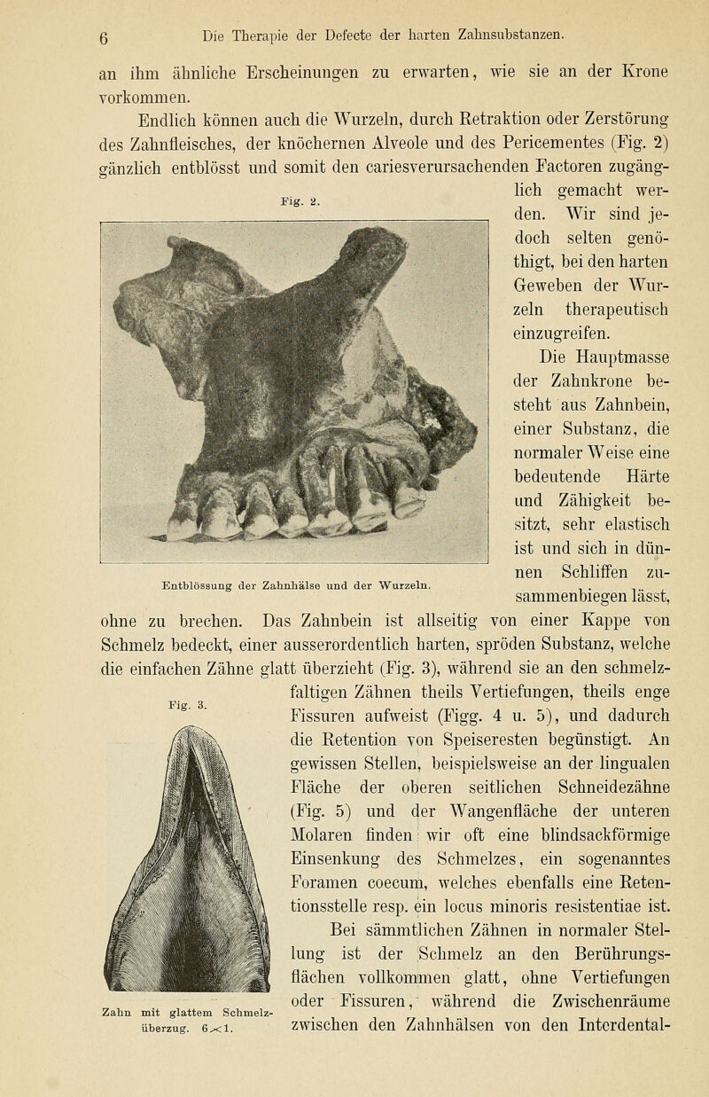 Fig. 2. an ihm ähnliche Erscheinungen zu erwarten, wie sie an der Krone vorkommen. Endhch können auch die Wurzeln, durch Retraktion oder Zerstörung des Zahnfleisches, der knöchernen Alveole und des Pericementes (Fig. 2) gänzlich entblösst und somit den cariesverursachenden Factoren zugäng- lich gemacht wer- den. Wir sind je- doch selten genö- thigt, bei den harten Geweben der Wur- zeln therapeutisch einzugreifen. Die Hauptmasse der Zahnkrone be- steht aus Zahnbein, einer Substanz, die normaler Weise eine bedeutende Härte und Zähigkeit be- sitzt, sehr elastisch ist und sich in dün- nen Schliffen zu- sammenbiegen lässt, ohne zu brechen. Das Zahnbein ist allseitig von einer Kappe von Schmelz bedeckt, einer ausserordentlich harten, spröden Substanz, welche die einfachen Zähne glatt überzieht (Fig. 3), während sie an den schmelz- faltigen Zähnen theils Vertiefungen, theils enge Fissuren aufweist (Figg. 4 u. 5), und dadurch die Retention von Speiseresten begünstigt. An gewissen Stellen, beispielsweise an der lingualen Fläche der oberen seithchen Schneidezähne (Fig. 5) und der Wangenfläche der unteren Molaren finden wir oft eine blindsackförmige Einsenkung des Schmelzes, ein sogenanntes Foramen coecum, welches ebenfalls eine Reten- li<msstelle resp. ein locus minoris resistentiae ist. Bei sämmtlichen Zähnen in normaler Stel- lung ist der Schmelz an den Berührungs- flächen vollkommen glatt, ohne Vertiefungen oder Fissuren, während die Zwischenräume Zahn mit glattem Schmelz- überzug. 6^1. zwischen den Zahnhälsen von den Intcrdental- Enthlössung der Zahnhälse und der Wurzeln.