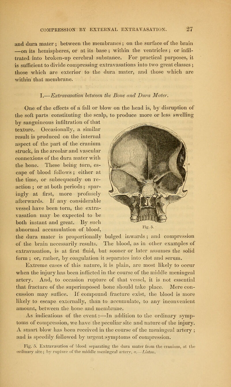 and dura mater ; between the membranes; on the surface of the brain —on its hemispheres, or at its base ; within the ventricles; or infil- trated into broken-up cerebral substance. For practical purposes, it is sufficient to divide compressing extravasations into two great classes ; those which are exterior to the dura mater, and those Avhich are Avithin that membrane. I.—Extravasation between the Bone and Dura Mater. One of the effects of a fall or blow on the head is, by disruption of the soft parts constituting the scalp, to produce more or less swelling by sanguineous infiltration of that texture. Occasionally, a similar result is produced on the internal aspect of the part of the cranium struck, in the areolar and vascular connexions of the dura mater with the bone. These being torn, es- cape of blood follows ; either at the time, or subsequently on re- action ; or at both periods ; spai'- ingly at first, more profusely afterwards. If any considerable vessel have been torn, the extra- vasation may be expected to be both instant and great. By such abnormal accumulation of blood, the dura mater is proportionally bulged inwards ; and compression of the brain necessarily results. The blood, as in other examples of extravasation, is at first fluid, but sooner or later assumes the solid form ; or, rather, by coagulation it separates into clot and serum. Extreme cases of this nature, it is plain, are most likely to occur when the injury has been inflicted in the course of the middle meningeal artery. And, to occasion rupture of that vessel, it is not essential that fracture of the superimposed bone should take place. Mere con- cussion may suffice. If compound fracture exist, the blood is more likely to escape externally, than to accumulate, to any inconvenient amount, between the bone and membrane. As indications of the event:—In addition to the ordinary symp- toms of compression, we have the peculiar site and nature of the injury. A smart blow has been received in the course of the meningeal artery ; and is speedily followed by ui'gent. symptoms of compression. Fig. 5. Extravasation of blood separating the dura mater from tlie cranium, at the ordinary site; by rupture of the middle meningeal artery, a.— Liston.