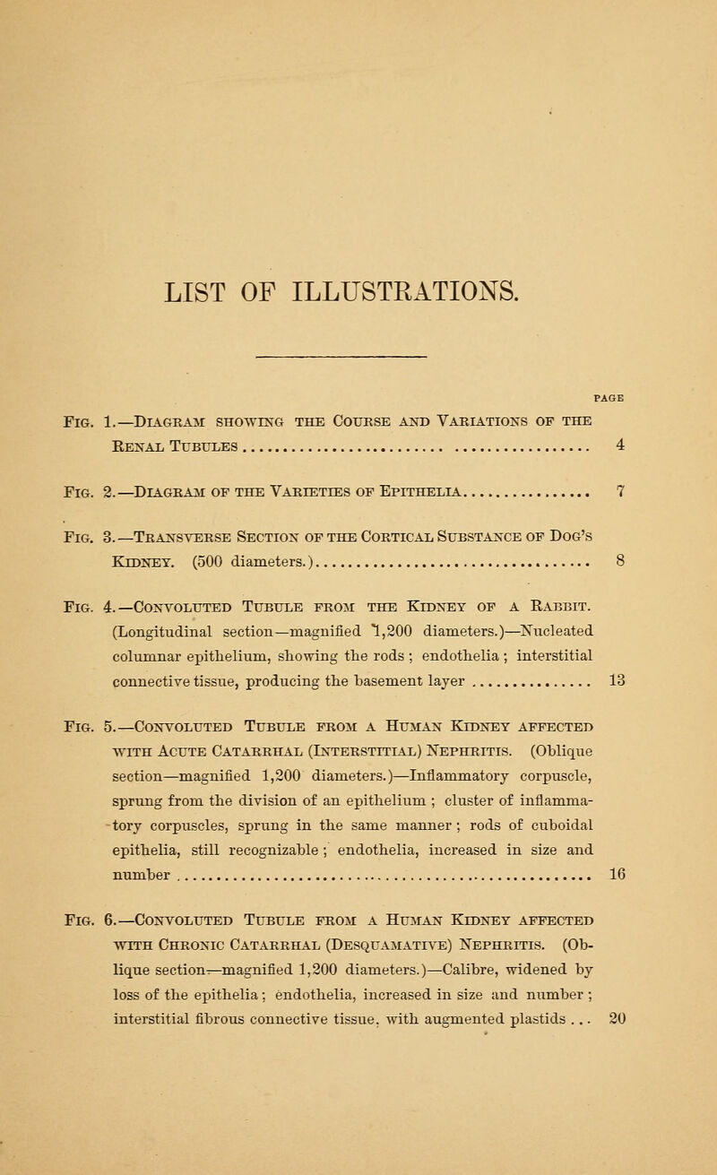 LIST OF ILLUSTRATIONS. PAGE Fig. 1.—DiAGKAM SHOwmo the Course and Variations of the Renal Tubules 4 Fig. 2. —Diagram of the Vareettes of Epithelia 7 Fig. 3.—Transverse Section of the Cortical Substance op Dog's Kidney. (500 diameters.) 8 Fig. 4.—Convoluted Tubule froji the Kidney of a Rabbit. (Longitudinal section—magnified 1,200 diameters.)—Nucleated columnar epitlielium, showing the rods ; endothelia ; interstitial connective tissue, producing the basement layer 13 Fig. 5.—Convoluted Tubule from a Human Kidney affected with Acute Catarrhal (Interstitial) Nephritis. (Ohlique section—magnified 1,200 diameters.)—Inflammatory corpuscle, sprung from the division of an epithelium ; cluster of inflamma- -tory corpuscles, sprung in the same manner ; rods of cuboidal epithelia, still recognizable ; endothelia, increased in size and number 16 Fig. 6.—Convoluted Tubule from a Human Kidney affected WITH Chronic Catarrhal (Desquamative) Nephritis. (Ob- lique sectionT—magnified 1,200 diameters.)—Calibre, widened by loss of the epithelia; endothelia, increased in size and number ; interstitial fibrous connective tissue, with augmented plastids ... 20