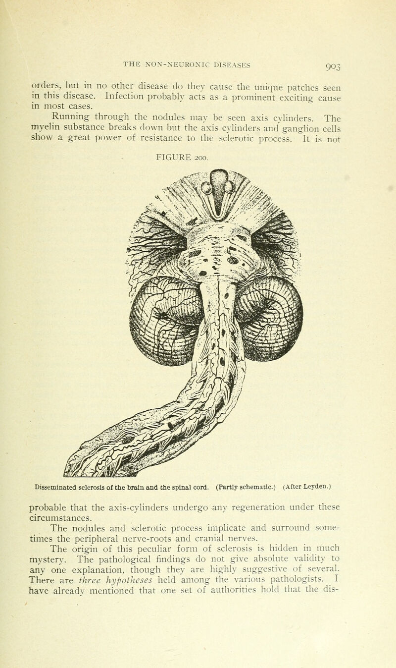 orders, but in no other disease do they cause the unique patches seen in this disease. Infection probably acts as a prominent exciting cause in most cases. Running through the nodules may be seen axis cylinders. The myelin substance breaks down but the axis cylinders and' ganglion cells show a great power of resistance to the sclerotic process. It is not FIGURE 200. Disseminated sclerosis of the brain and the spinal cord. (Partly schematic.) (After Leyden.) probable that the axis-cylinders midergo any regeneration under these circumstances. The nodules and sclerotic process implicate and surround some- times the peripheral nerve-roots and cranial nerves. The origin of this peculiar form of sclerosis is hidden in much mystery. The pathological findings do not give absolute validity to any one explanation, though they are highly suggestive of several. There are three hypotheses held among the various pathologists. I have alreadv mentioned that one set of authorities hold that the dis-