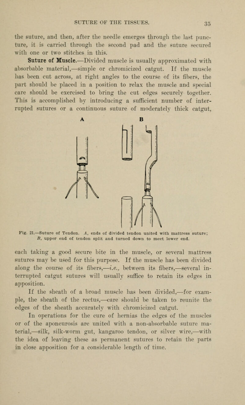 the suture, and then, after the needle emerges througli the last punc- ture^, it is carried through the second pad and the suture secured with one or two stitches in this. Suture of Muscle.—Divided muscle is usually approximated with absorbable nuiterial.—simple or chromicized catgut. If the muscle has been cut across, at right angles to the course of its fibers, the part should be placed in a position to relax the muscle and special care should be exercised to bring the cut edges securely together. This is accomplished by introducing a sufficient number of inter- rupted sutures or a continuous suture of moderately thick catgut, A B Fig. 21.—Suture of Tendon. A, ends of divided tendon united with mattress suture; B, upper end of tendon split and turned down to meet lower end. each t-aking a good secure bite in the muscle, or several mattress sutures may be used for this purpose. If the muscle has been divided along the course of its fibers,—i.e., between its fibers,—several in- terrupted catgut sutures will usually suffice to retain its edges in apposition. If the sheath of a broad muscle has been divided,—for exam- ple, the sheath of the rectus,—care should be taken to reunite the edges of the sheath accurately with chromicized catgut. In operations for the cure of hernias the edges of the muscles or of the aponeurosis are united with a non-absorbable suture ma- terial,—silk, silk-wonn gut. kangaroo tendon, or silver wire,—with the idea of leaving these as permanent sutures to retain the parts in close apposition for a considerable length of time.