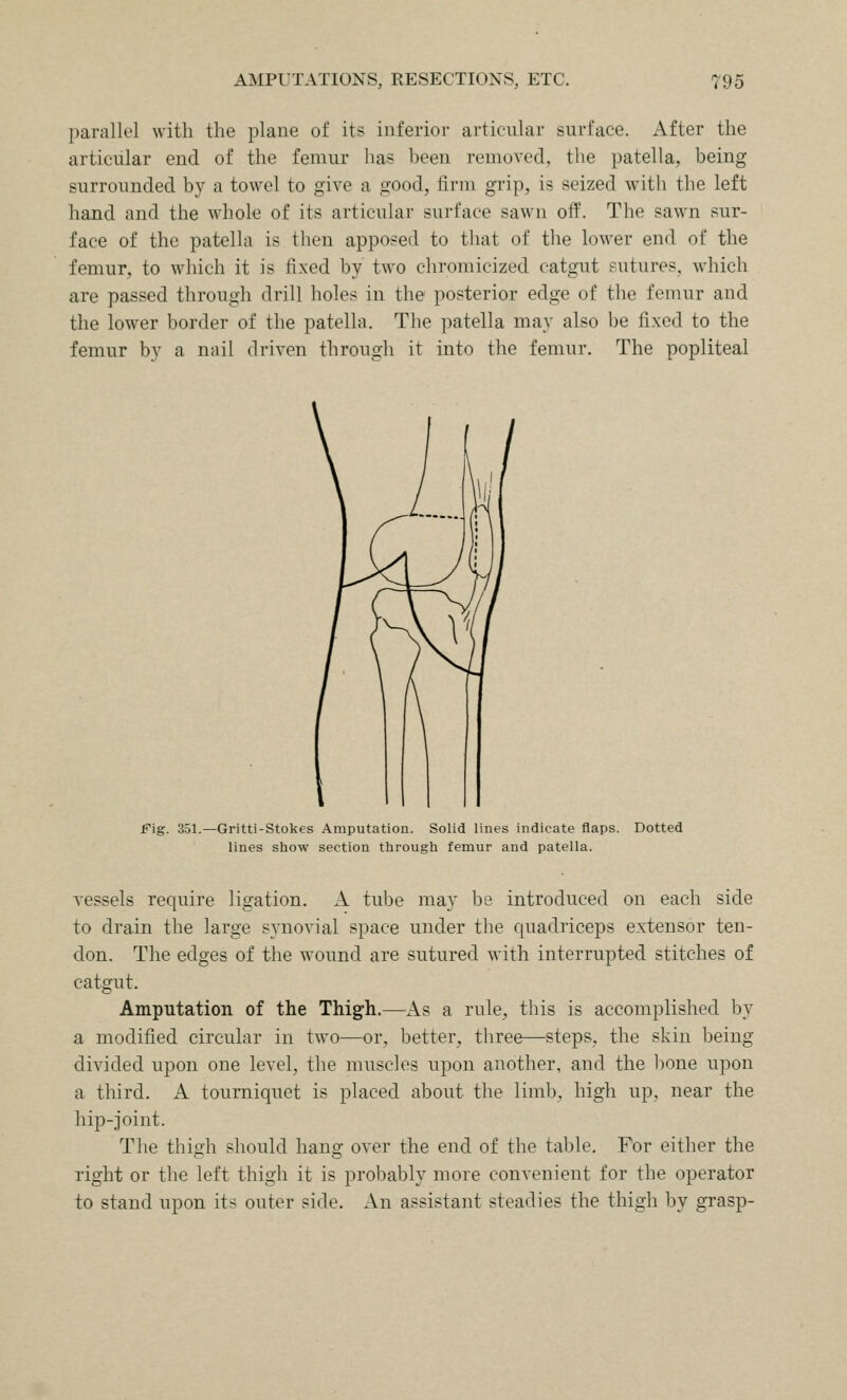 parallel with the plane of its inferior articular surface. i\.fter the articular end of the femur has been removed, the patella, being surrounded by a towel to give a good, firm grip, is seized with the left hand and the whole of its articular surface sawn off. The sawn sur- face of the patella is then apposed to that of the lower end of the femur, to which it is fixed by two chromicized catgut sutures, which are passed through drill holes in the posterior edge of the femur and the lower border of the patella. The patella may also be fixed to the femur by a nail driven through it into the femur. The popliteal -Gritti-Stokes Amputation. Solid lines indicate flaps, lines show section through femur and patella. Dotted vessels require ligation. A tube may be introduced on each side to drain the large synovial space under the quadriceps extensor ten- don. The edges of the wound are sutured with interrupted stitches of catgut. Amputation of the Thigh.—As a rule, this is accomplished by a modified circular in two—or, better, three—steps, the skin being divided upon one level, the muscles upon another, and the bone upon a third. A tourniquet is placed about the limb, high up, near the hip-joint. The thigh should hang over the end of the table. For either the right or the left thigh it is probably more convenient for the operator to stand upon its outer side. An assistant steadies the thigh by grasp-