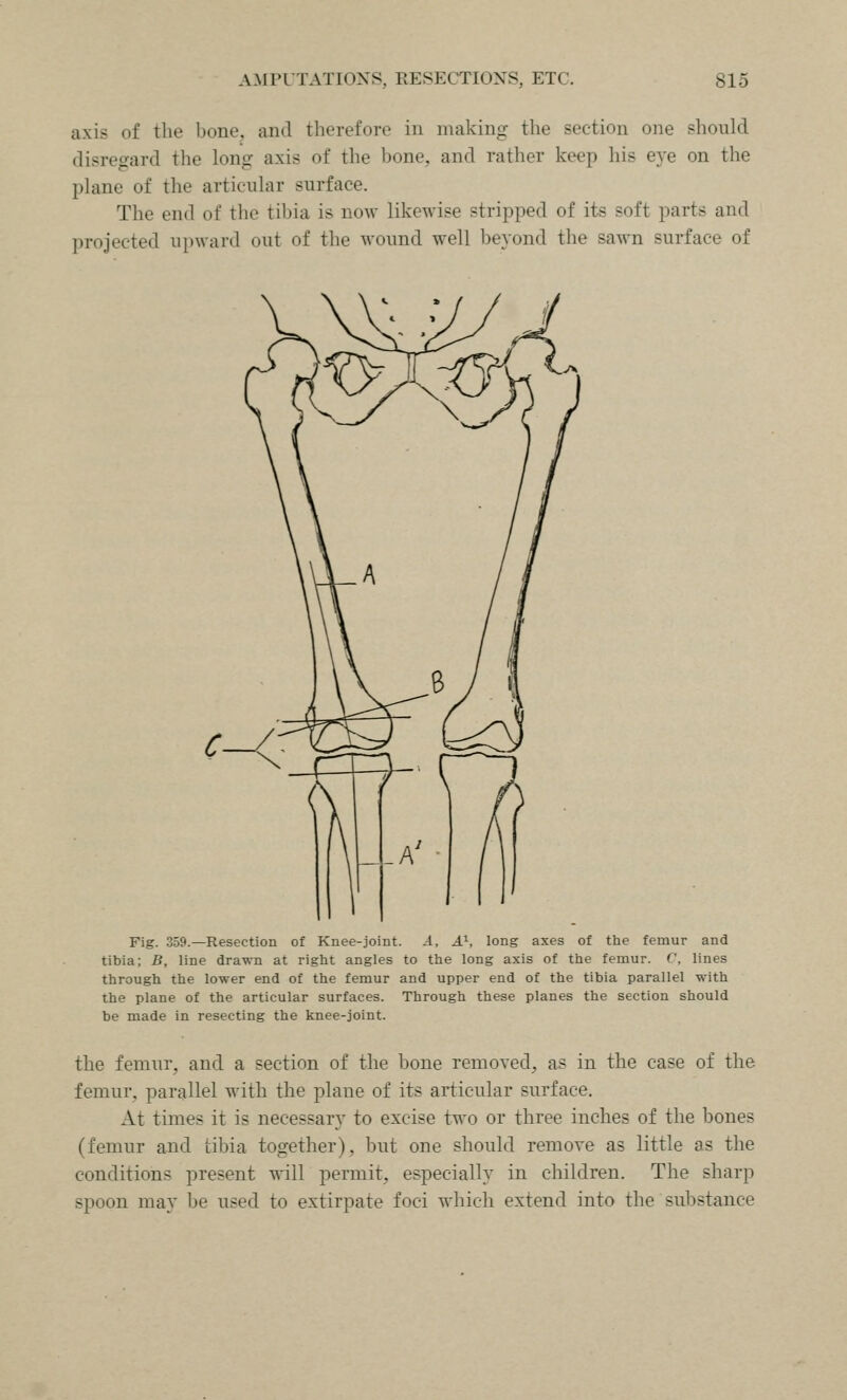 axis of the bone, and therefore in making the section one should disre<yard the long axis of the bone, and rather keep his eye on the plane of the articular surface. The end of the tibia is now likewise stripped of its soft parts and projected upward out of the wound well beyond the sawn surface of C- Fig. 359.—Resection of Knee-joint. A, A?-, long axes of ttie femur and tibia; B, line drawn at right angles to the long axis of the femur. C, lines through the lower end of the femur and upper end of the tibia parallel with the plane of the articular surfaces. Through these planes the section should be made in resecting the knee-joint. the femur, and a section of the bone removed, as in the case of the femur, parallel with the plane of its articular surface. At times it is necessary to excise two or three inches of the bones (femur and tibia together), but one should remove as little as the conditions present will permit, especially in children. The sharp spoon may be used to extirpate foci which extend into the substance