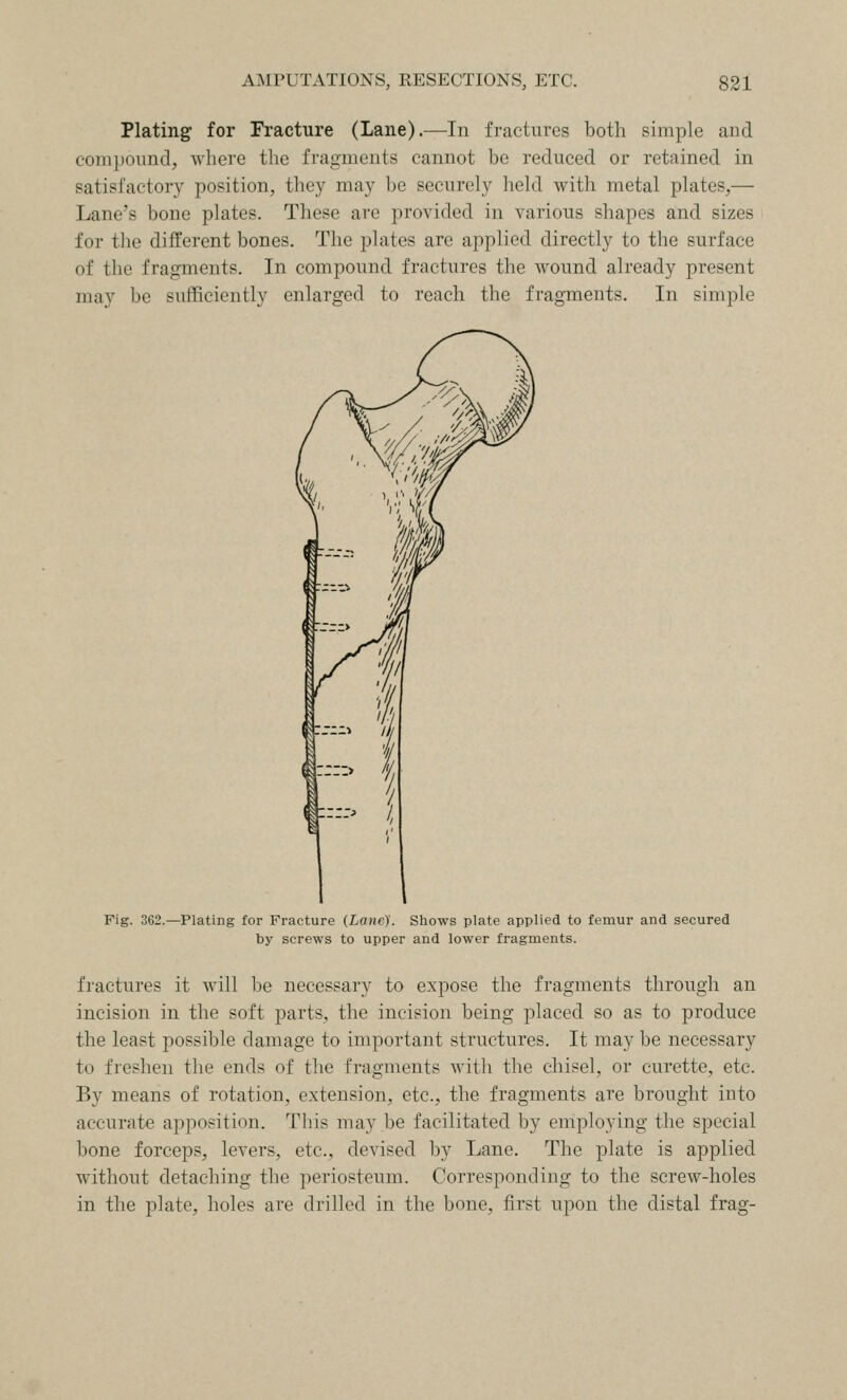 Plating for Fracture (Lane).—In fractures both simple and compound, where the fragments cannot bo reduced or retained in satisfactory position, they may be securely held with metal plates,— Lane's bone plates. These are provided in various shapes and sizes for the different bones. The plates arc applied directly to the surface of the fragments. In compound fractures the wound already present may be sufficiently enlarged to reach the fragments. In simple Fig. 362.—Plating for Fracture (Lane). Shows plate applied to femur and secured by screws to upper and lower fragments. fractures it will be necessary to expose the fragments through an incision in the soft parts, the incision being placed so as to produce the least possible damage to important structures. It may be necessary to freshen the ends of the fragments with the chisel, or curette, etc. By means of rotation, extension, etc., the fragments are brought into accurate apposition. This may be facilitated by employing the special bone forceps, levers, etc., devised by Lane. The plate is applied without detaching the periosteum. Corresponding to the screw-holes in the plate, holes are drilled in the bone, first upon the distal frag-