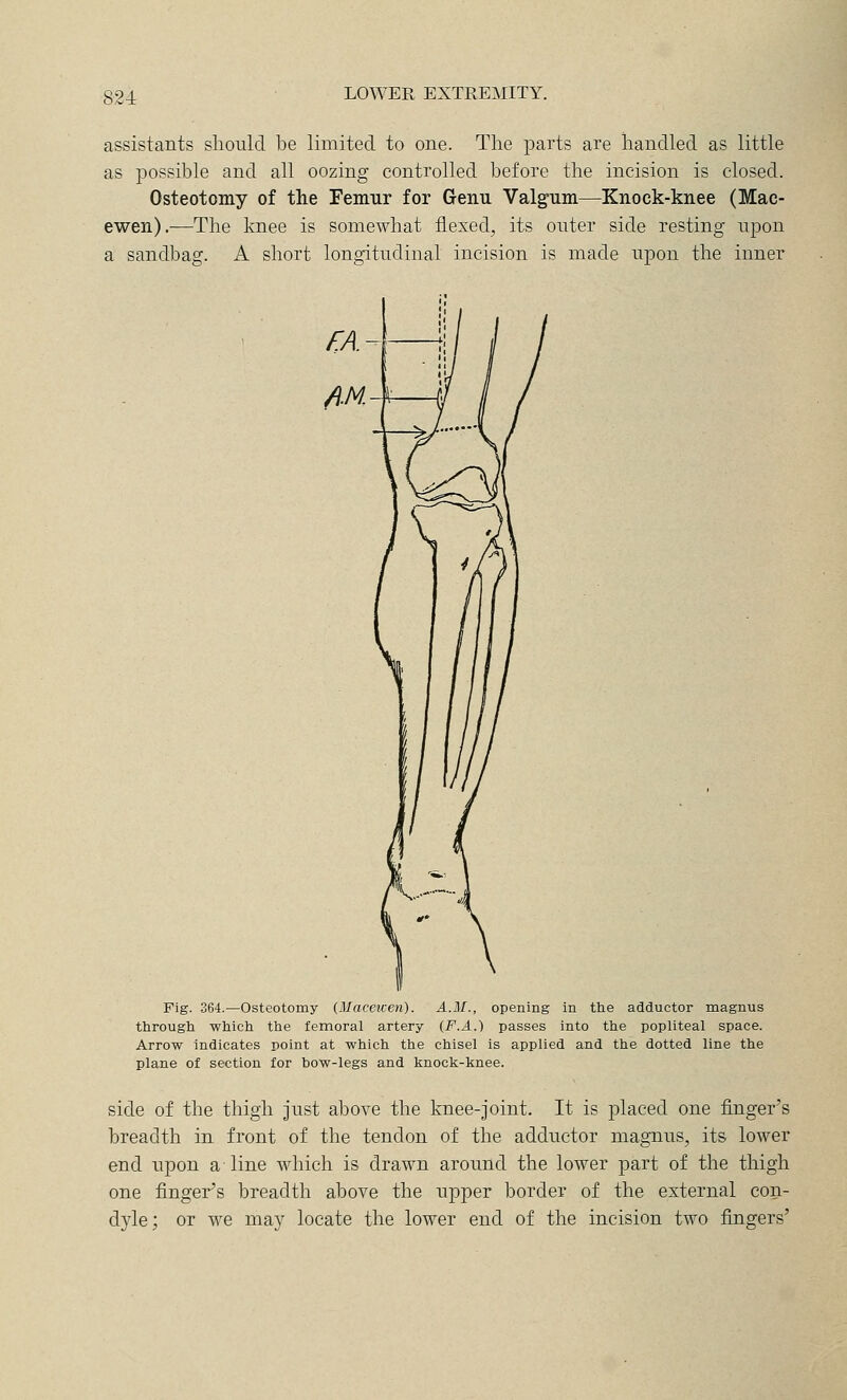 821 assistants should be limited to one. The parts are handled as little as 230ssible and all oozing controlled before the incision is closed. Osteotomy of the Femur for Genu Valgum—Knock-knee (Mac- ewen).—The knee is somewhat flexed, its outer side resting upon a sandbag. A short longitudinal incision is made upon the inner Fig. 364.—Osteotomy (Macewen). A.M., opening in the adductor magnus through which the femoral artery (F.A.) passes into the popliteal space. Arrow indicates point at which the chisel is applied and the dotted line the plane of section for bow-legs and knock-knee. side of the thigh just above the knee-joint. It is placed one finger's breadth in front of the tendon of the adductor magnus, its loAver end upon a line which is drawn around the lower part of the thigh one finger's breadth above the upper border of the external con- dyle; or we may locate the lower end of the incision two fingers'