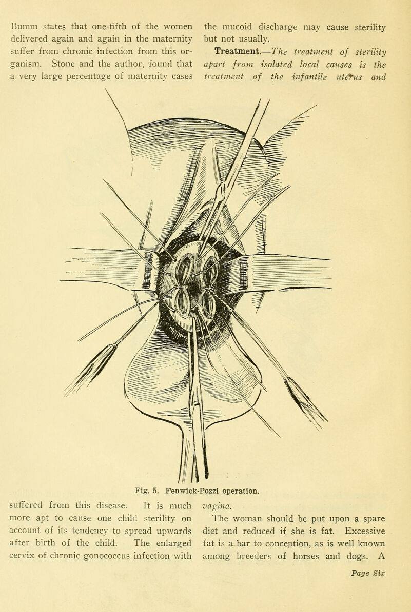 Bumm states that one-fifth of the women deHvered again and again in the maternity suffer from chronic infection from this or- ganism. Stone and the author, found that a very large percentage of maternity cases the mucoid discharge may cause sterility but not usually. Treatment.—The treatment of sterility apart from isolated local causes is the treatment of the infantile uterus and suft'ered from this disease, more apt to cause one child sterility on account of its tendency to spread upwards after birth of the child. The enlarged cervix of chronic gonococcus infection with Fig. 5. Fenwick-Pozzi operation It is much vagina. The woman should be put upon a spare diet and reduced if she is fat. Excessive fat is a bar to conception, as is well known among breeders of horses and dogs. A