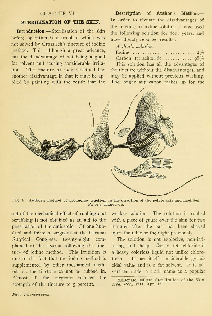 CHAPTER VI. STERILIZATION OF THE SKIN. Introduction.— Sterilization of the skin before operation is a problem which was not solved by Grossisch's tincture of iodine method. This, although a great advance, has the disadvantage of not being a good fat solvent and causing considerable irrita- tion. The tincture of iodine method has another disadvantage in that it must be ap- plied by painting with the result that the Description of Author's Method.— In order to obviate the disadvantages of the tincture of iodine solution I have used the following solution for four years, and have already reported results^. Author's' solution: Iodine 2% Carbon tetrachloride 9^% This solution has all the advantages of the tincture without the disadvantages, and may be applied without previous washing. The longer application makes up for the Fig. 4. Author's method of producing traction in the direction of the pelvic axis and modified Pajor's maneuvre. aid of the mechanical effect of rubbing and scrubbing is not obtained as an aid to the penetration of the antiseptic. Of one hun- dred and thirteen surgeons at the German Surgical Congress, twenty-eight com- plained of the eczema following the tinc- ture of iodine method. This irritation is due to the fact that the iodine method is supplemented by other mechanical meth- ods as the tincture cannot be rubbed in. Almost all the surgeons reduced the strength of the tincture to 5 percent. weaker solution. The solution is rubbed with a piece of gauze over the skin for two minutes after the part has been shaved upon the table or the night previously. The solution is not explosive, non-irri- tating, and cheap. Carbon tetrachloride is a heavy colorless liquid not unlike chloro- form. It has itself considerable germi- cidal value and is a fat solvent. It is ad- vertised under a trade name as a popular ^McDonald, Ellice: Sterilization of the Skin. Med. Rec, 1911, Apr. 15.