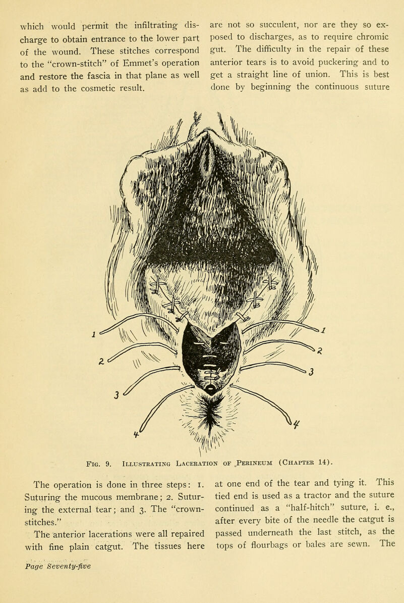 which would permit the infiltrating dis- charge to obtain entrance to the lower part of the wound. These stitches correspond to the crown-stitch of Emmet's operation and restore the fascia in that plane as well as add to the cosmetic result. are not so succulent, nor are they so ex- posed to discharges, as to require chromic gut. The difficulty in the repair of these anterior tears is to avoid puckering and to get a straight line of union. This is best done by beginning the continuous suture Fig. 9. Illustrating Laceration of Perineum (Chapter 14). The operation is done in three steps: i. Suturing the mucous membrane; 2. Sutur- ing the external tear; and 3. The crown- stitches. The anterior lacerations were all repaired with fine plain catgut. The tissues here at one end of the tear and tying it. This tied end is used as a tractor and the suture continued as a half-hitch suture, i. e., after every bite of the needle the catgut is passed underneath the last stitch, as the tops of flourbags or bales are sewn. The