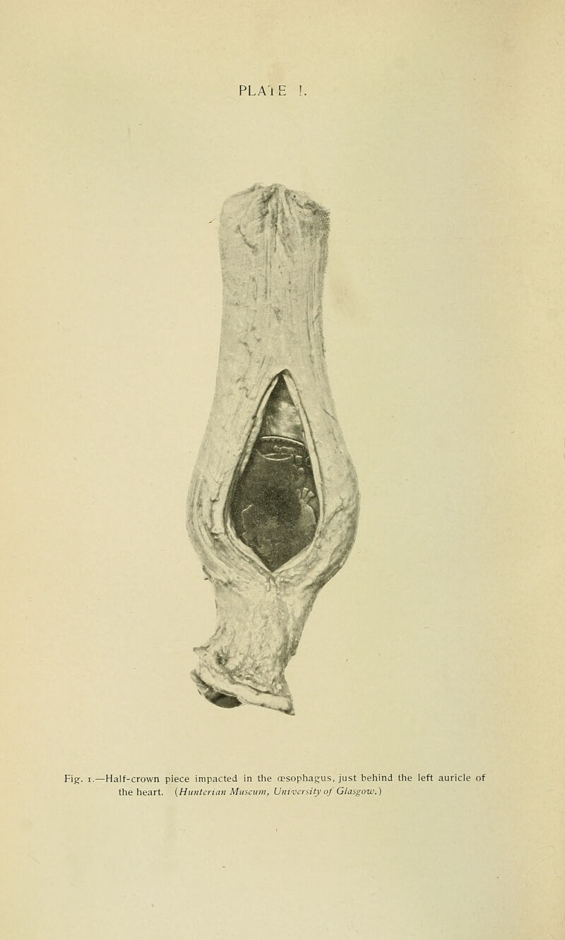 PLA'lE !. ..>' % ^^^ Fig. I.—Half-crown piece impacted in the cesophagus, just behind the left auricle of the heart. {Hunterian Museum, University of Glaigow.)