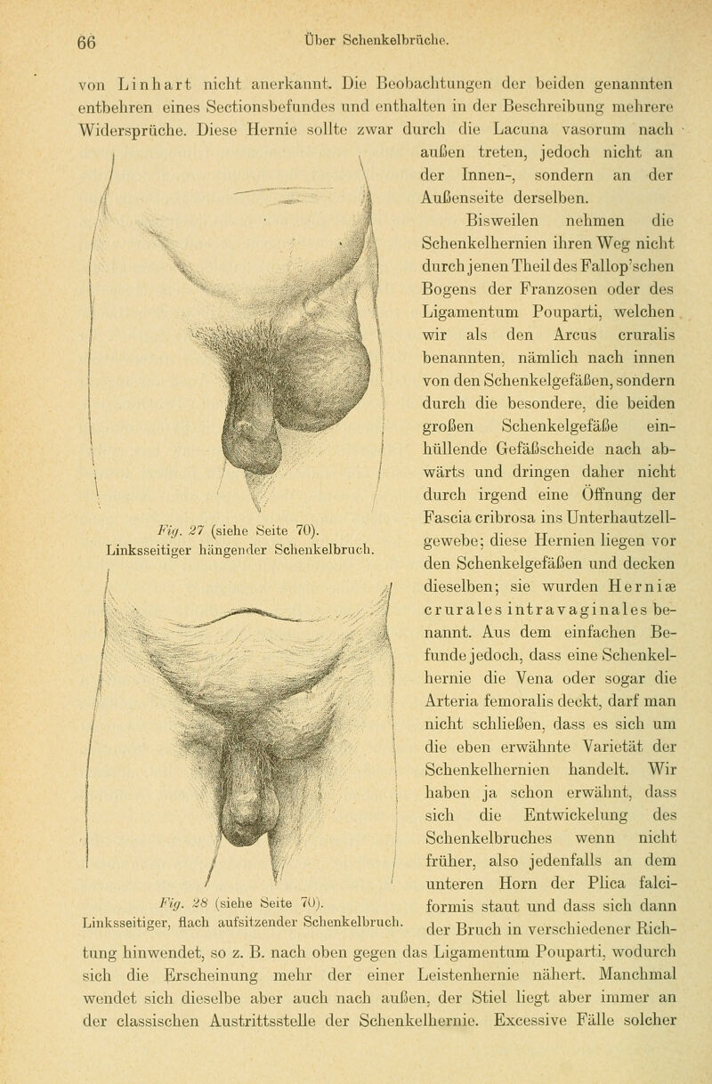 von Linhart nicht anerkannt. Diu Boobachtungon der beiden genannten entbehren eines Sectionsbefundes und enthalten in der Beschreibung mehrere Widersprüche. Diese Hernie sollte zwar durch die Lacuna vasorum nach außen treten, jedoch nicht an der an Fig. 27 (siehe Seite 70). Linksseitiger hängender Schenkelbruch. der Innen-, sondern Außenseite derselben. Bisweilen nehmen die Schenkelhernien ihren Weg nicht durch jenen Theil des Fallop'schen Bogens der Franzosen oder des Ligamentum Pouparti, welchen wir als den Arcus cruralis benannten, nämlich nach innen von den Schenkelgefäßen, sondern durch die besondere, die beiden großen Schenkelgefäße ein- hüllende Gefäßscheide nach ab- wärts und dringen daher nicht durch irgend eine Öffnung der Fascia cribrosa ins ünterhautzell- gewebe; diese Hernien liegen vor den Schenkelgefäßen und decken dieselben; sie wurden Hernise crurales intravaginales be- nannt. Aus dem einfachen Be- funde jedoch, dass eine Schenkel- hernie die Vena oder sogar die Arteria femoralis deckt, darf man nicht schließen, dass es sich um die eben erwähnte Varietät der Schenkelhernien handelt. Wir haben ja schon erwähnt, dass sich die Entwickelung des Schenkelbruches wenn nicht früher, also jedenfalls an dem unteren Hörn der Flica falci- formis staut und dass sich dann der Bruch in verschiedener Rich- tung hinwendet, so z. B. nach oben gegen das Ligamentum Pouparti, wodurch sich die Jp^rscheinung mehr der einer Leistenhernie nähert. Manchmal wendet sich dieselbe aber auch nach außen, der Stiel liegt aber immer an der classischen Austrittsstelle der Schenkelhernie. Excessive Fälle solcher Fig. 28 (siehe Seite 7U). Linksseitiger, flach aufsitzender Schenkelbruch