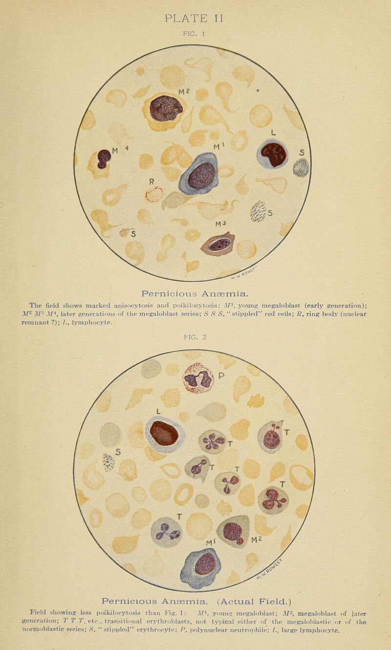 FIG. 1 Pernicious Ansemia. The field shows marked anisocytosis and poikilocytosis: -If, young megaloblast (early generation); M- M'^ M*, later generations of the megaloblast series; S S S, stippled red cells; R, ring body (nuclear remnant ?); L, lymphocyte. FIG. 2 Pernicious Anaemia. (Actual Field.) Field showing less poikilocytosis than Fig. 1: M^, young megaloblast; M-, megaloblast of later generation; T T T, etc., transitional erythroblasts, not typical either of the megaloblastic or of the normoblastic series; S, stippled erythrocyte; P, polynuclear neutrophile; L, large lymphocyte.