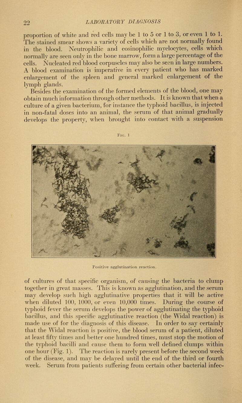 proportion of white and red cells may be 1 to 5 or 1 to 3, or even 1 to 1. The stained smear shows a variety of cells which are not normally found in the blood. Neutrophilic and eosinophilic myelocytes, cells which normally are seen only in the bone marrow, form a large percentage of the cells. Nucleated red blood corpuscles may also be seen in large numbers. A blood examination is imperative in every patient who has marked enlargement of the spleen and general marked enlargement of the lymph glands. Besides the examination of the formed elements of the blood, one may obtain much information through other methods. It is known that when a culture of a given bacterium, for instance the typhoid bacillus, is injected in non-fatal doses into an animal, the serum of that animal gradually develops the property, when brought into contact with a suspension Fig. 1 Positive agglutination reaction. of cultures of that specific organism, of causing the bacteria to clump together in great masses. This is known as agglutination, and the serum may develop such high agglutinative properties that it will be active when diluted 100, 1000, or even 10,000 times. During the course of typhoid fever the serum develops the power of agglutinating the typhoid bacillus, and this specific agglutinative reaction (the Widal reaction) is made use of for the diagnosis of this disease. In order to say certainly that the Widal reaction is positive, the blood serum of a patient, diluted at least fifty times and better one hundred times, must stop the motion of the typhoid bacilli and cause them to form well defined clumps within one hour (Fig. 1). The reaction is rarely present before the second week of the disease, and may be delayed until the end of the third or fourth week. Serum from patients suffering from certain other bacterial infec-