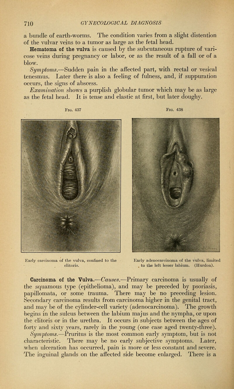 a bundle of earth-worms. The condition varies from a slight distention of the vulvar veins to a tumor as large as the fetal head. Hematoma of the vulva is caused by the subcutaneous rupture of vari- cose veins during pregnancy or labor, or as the result of a fall or of a blow. Symptoms.—Sudden pain in the affected part, with rectal or vesical tenesmus. Later there is also a feeling of fulness, and, if suppuration occurs, the signs of abscess. Examination shows a purplish globular tumor which may be as large as the fetal head. It is tense and elastic at first, but later doughy. Fig. 437 Fig. 438 Early carcinoma of the vulva, confined to the clitoris. Early adenocarcinojna of the vulva, limited . to the left lesser labium. (Hurdon). Carcinoma of the Vulva.—Causes.—Primary carcinoma is usually of the squamous type (epithelioma), and may be preceded by psoriasis, papillomata, or some trauma. There may be no preceding lesion. Secondary carcinoma results from carcinoma higher in the genital tract, and may be of the cylinder-cell variety (adenocarcinoma). The growth begins in the sulcus between the labium ma jus and the nympha, or upon the clitoris or in the urethra. It occurs in subjects between the ages of forty and sixty years, rarely in the young (one case aged twenty-three). Symptoms.-—^Pruritus is the most common early symptom, but is not characteristic. There may be no early subjective symptoms. Later, when ulceration has occurred, pain is more or less constant and severe. The inguinal glands on the affected side become enlarged. There is a