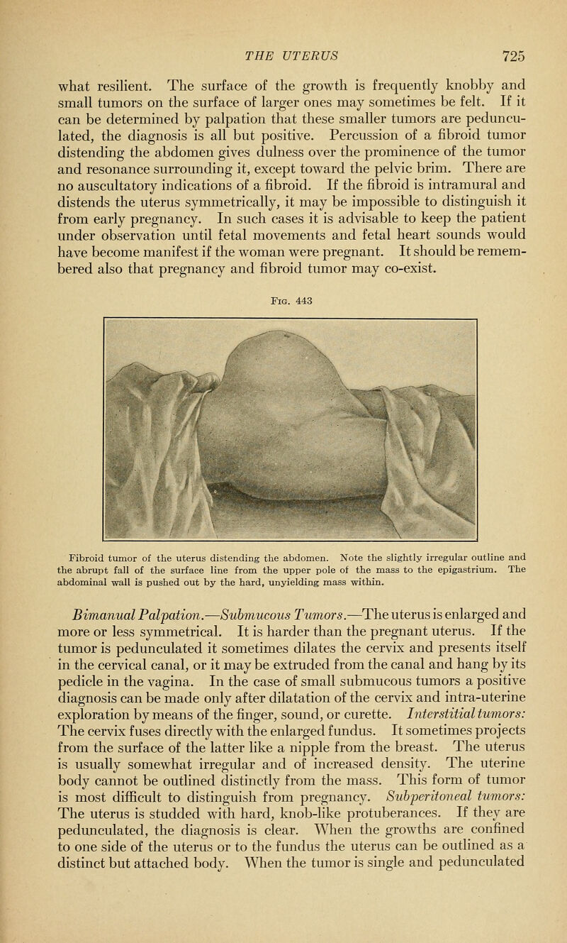 what resilient. The surface of the growth is frequently knobby and small tumors on the surface of larger ones may sometimes be felt. If it can be determined by palpation that these smaller tumors are peduncu- lated, the diagnosis is all but positive. Percussion of a fibroid tumor distending the abdomen gives dulness over the prominence of the tumor and resonance surrounding it, except toward the pelvic brim. There are no auscultatory indications of a fibroid. If the fibroid is intramural and distends the uterus symmetrically, it may be impossible to distinguish it from early pregnancy. In such cases it is advisable to keep the patient under observation until fetal movements and fetal heart sounds would have become manifest if the woman were pregnant. It should be remem- bered also that pregnancy and fibroid tumor may co-exist. Fig. 443 Fibroid tumor of the uterus distending the abdomen. Note the slightly irregular outline and the abrupt fall of the surface line from the upper pole of the mass to the epigastrium. The abdominal wall is pushed out by the hard, unyielding mass within. Bimanual Palpation.—Submucous Tumors.—The uterus is enlarged and more or less symmetrical. It is harder than the pregnant uterus. If the tumor is pedunculated it sometimes dilates the cervix and presents itself in the cervical canal, or it may be extruded from the canal and hang by its pedicle in the vagina. In the case of small submucous tumors a positive diagnosis can be made only after dilatation of the cervix and intra-uterine exploration by means of the finger, sound, or curette. Interstitial tumors: The cervix fuses directly with the enlarged fundus. It sometimes projects from the surface of the latter like a nipple from the breast. The uterus is usually somewhat irregular and of increased density. The uterine body cannot be outlined distinctly from the mass. This form of tumor is most difficult to distinguish from pregnancy. Subperitoneal tumors: The uterus is studded with hard, knob-like protuberances. If they are pedunculated, the diagnosis is clear. When the growths are confined to one side of the uterus or to the fundus the uterus can be outlined as a distinct but attached body. When the tumor is single and pedunculated