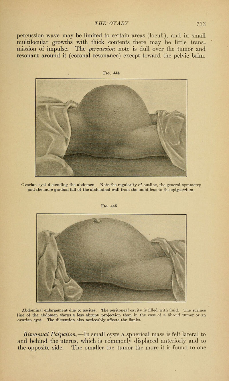 percussion wave may be limited to certain areas (loculi), and in small multilocular growths with thick contents there may be little trans- mission of impulse. The 'percussion note is dull over the tumor and resonant around it (coronal resonance) except toward the pelvic brim. Fig. 444 Ovarian cyst distending the abdomen. Note the regularity of outline, the general sjmametry and the more gradual fall of the abdominal wall from the umbilicus to the epigastrium. Fig. 445 Abdominal enlargement due to ascites. The peritoneal cavity is filled with fluid. The surface line of the abdomen shows a less abrupt projection than in the case of a fibroid tumor or an ovarian cyst. The distention also noticeably affects the flanks. Bimanual Palpation.—In small cysts a spherical mass is felt lateral to and behind the uterus, which is commonly displaced anteriorly and to the opposite side. The smaller the tumor the more it is found to one