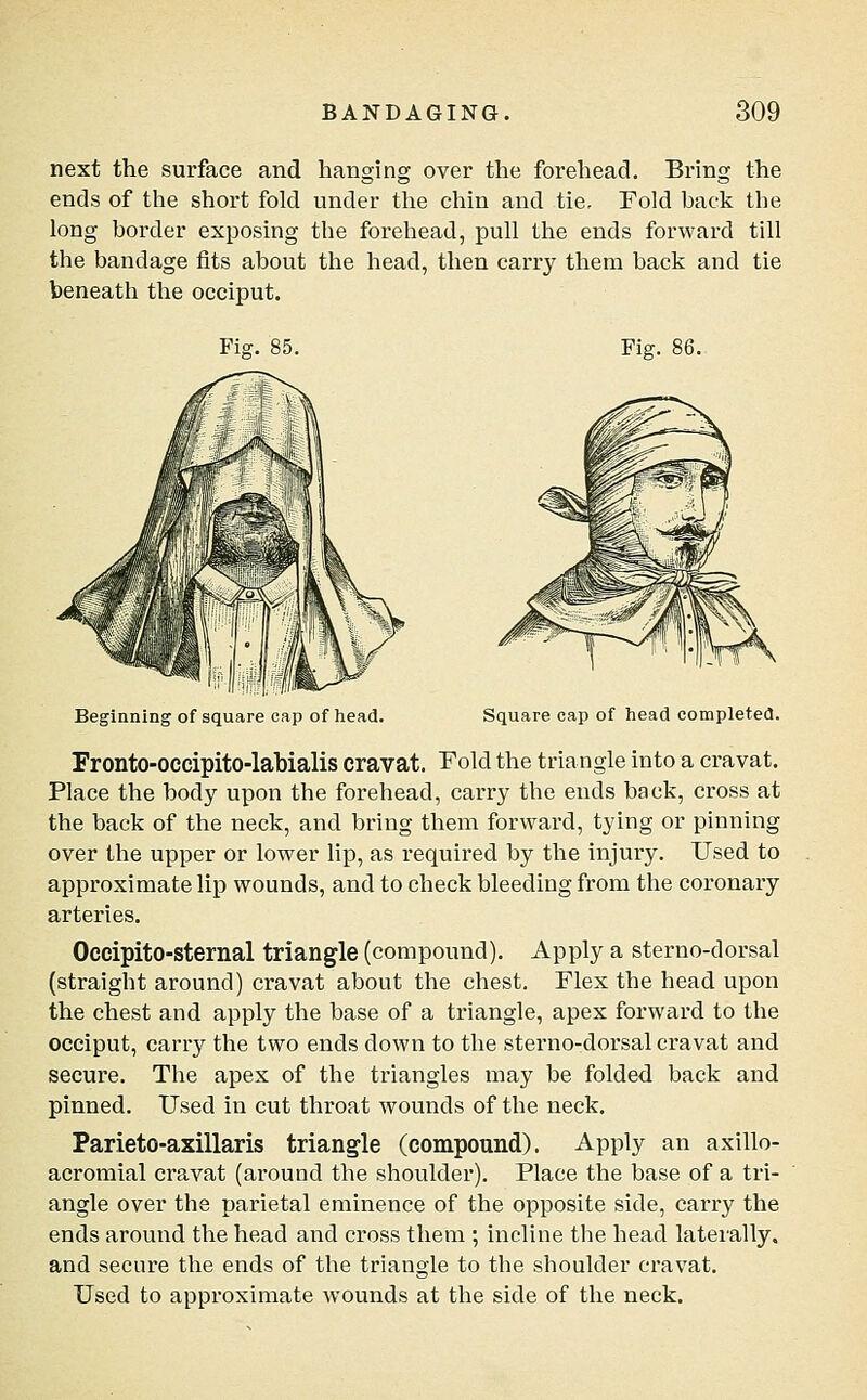 next the surface and hanging over the forehead. Bring the ends of the short fold under the chin and tie, Fold back the long border exposing the forehead, pull the ends forward till the bandage fits about the head, then carry them back and tie beneath the occiput. Fig. 85. Fig. 86. Beginning of square cap of head. Square cap of liead completed. Fronto-occipito-labialis cravat. Fold the triangle into a cravat. Place the body upon the forehead, carry the ends back, cross at the back of the neck, and bring them forward, tying or pinning over the upper or lower lip, as required by the injury. Used to approximate lip wounds, and to check bleeding from the coronary arteries. Occipito-sternal triangle (compound). Apply a sterno-dorsal (straight around) cravat about the chest. Flex the head upon the chest and apply the base of a triangle, apex forward to the occiput, carry the two ends down to the sterno-dorsal cravat and secure. The apex of the triangles may be folded back and pinned. Used in cut throat wounds of the neck. Parieto-axillaris triangle (compound). Apply an axillo- acromial cravat (around the shoulder). Place the base of a tri- angle over the parietal eminence of the opposite side, carry the ends around the head and cross them ; incline the head lateially. and secure the ends of the triangle to the shoulder cravat. Used to approximate wounds at the side of the neck.