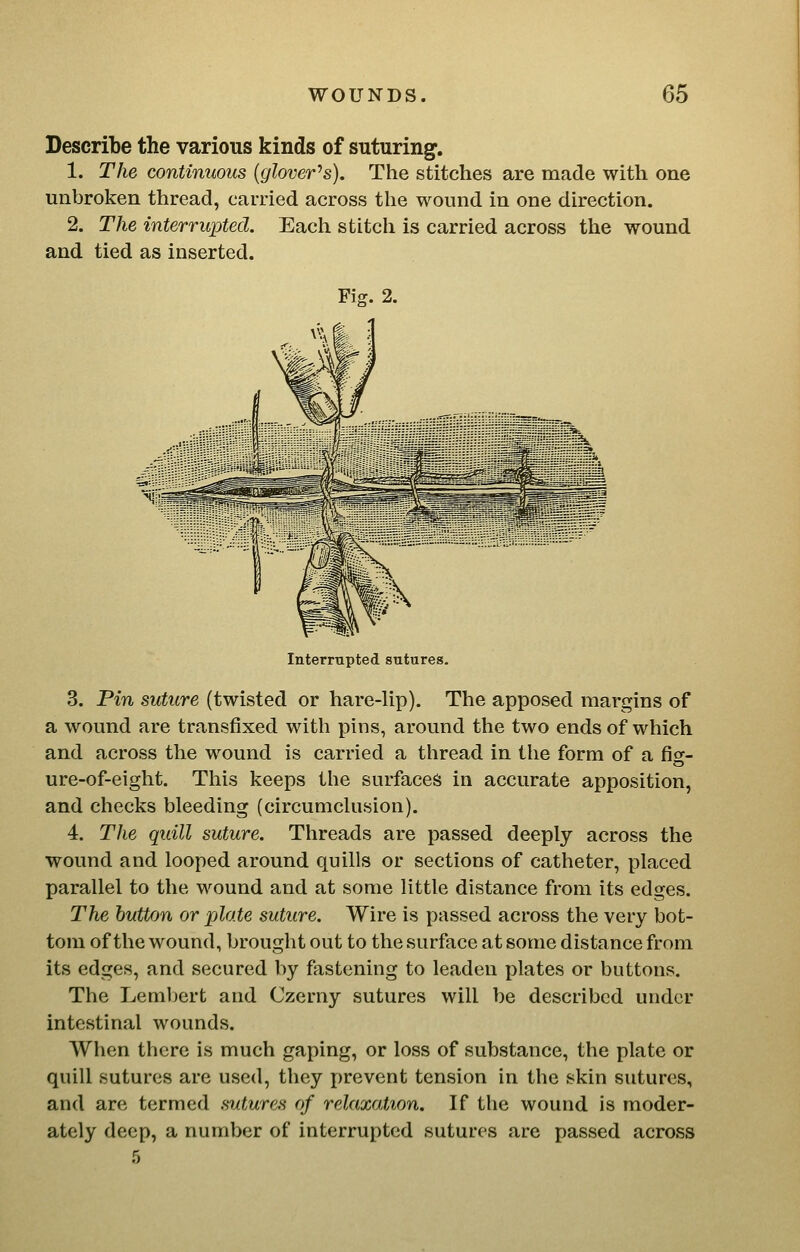 Describe the various kinds of suturing. 1. The continuous {glover''s). The stitches are made with one unbroken thread, carried across the wound in one direction. 2. The interrupted. Each stitch is carried across the wound and tied as inserted. Fig. 2. Interrnpted sutures. 3. Pin suture (twisted or hare-lip). The apposed margins of a wound are transfixed with pins, around the two ends of which and across the wound is carried a thread in the form of a fig- ure-of-eight. This keeps the surfaces in accurate apposition, and checks bleeding (circumchision). 4. The quill suture. Threads are passed deeply across the wound and looped around quills or sections of catheter, placed parallel to the wound and at some little distance from its edges. The button or plate suture. Wire is passed across the very bot- tom of the wound, brought out to the surface at some distance from its edges, and secured by fastening to leaden plates or buttons. The Lembert and Czerny sutures will be described under intestinal wounds. When there is much gaping, or loss of substance, the plate or quill sutures are used, they prevent tension in the skin sutures, and arc termed sutures of relaxation. If the wound is moder- ately deep, a number of interrupted sutures are passed across