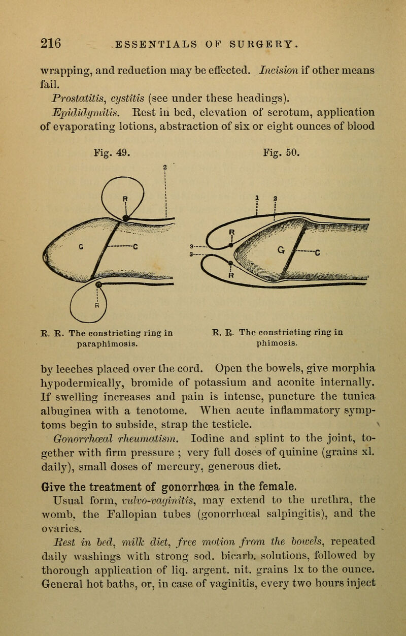 wrapping, and reduction may be effected. Incision if other means fail. Prostatitis, cystitis (see under these headings). epididymitis. Rest in bed, elevation of scrotum, application of evaporating lotions, abstraction of six or eight ounces of blood Fig. 49. Fig. 50. E. R. The constricting ring in paraphimosis. R. R. The constricting ring in phimosis. by leeches placed over the cord. Open the bowels, give morphia hypodermically, bromide of potassium and aconite internally. If swelling increases and pain is intense, puncture the tunica albuginea with a tenotome. When acute inflammatory symp- toms begin to subside, strap the testicle. ^ Gonorrhoeal rheumatism. Iodine and splint to the joint, to- gether with firm pressure ; very full doses of quinine (grains xl. daily), small doses of mercury, generous diet. Give the treatment of gonorrhoea in the female. Usual form, vidvo-vaginitis, may extend to the urethra, the womb, the Fallopian tubes (gonorrhoeal salpingitis), and the ovaries. Best in bed, milk diet, free motion from the bowels, repeated daily washings with strong sod. bicarb, solutions, followed by thorough application of liq. argent, nit. grains Ix to the ounce. General hot baths, or, in case of vaginitis, every two hours inject