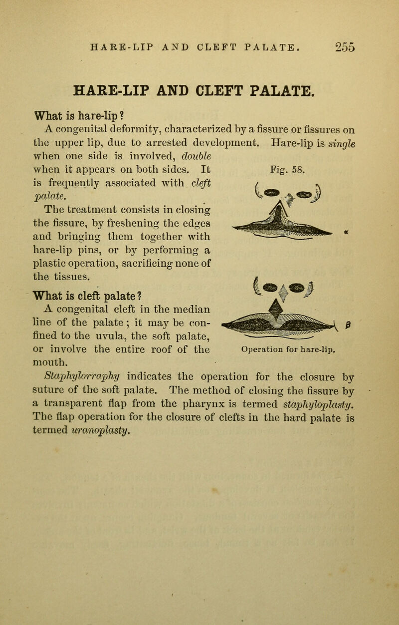 HARE-LIP AND CLEFT PALATE. Fig. 58. What is hare-lip ? A congenital deformity, characterized by a fissure or fissures on the upper lip, due to arrested development. Hare-lip is single when one side is involved, double when it appears on both sides. It is frequently associated with cleft palate. The treatment consists in closing the fissure, by freshening the edges and bringing them together with hare-lip pins, or by performing a plastic operation, sacrificing none of the tissues. What is cleft palate ? A congenital cleft in the median line of the palate ; it may be con- fined to the uvula, the soft palate, or involve the entire roof of the mouth. Staphylorraxjliy indicates the operation for the closure by suture of the soft palate. The method of closing the fissure by a transparent flap from the pharynx is termed staphyloplasty. The flap operation for the closure of clefts in the hard palate is termed uranoplasty. Operation for hare-lip.